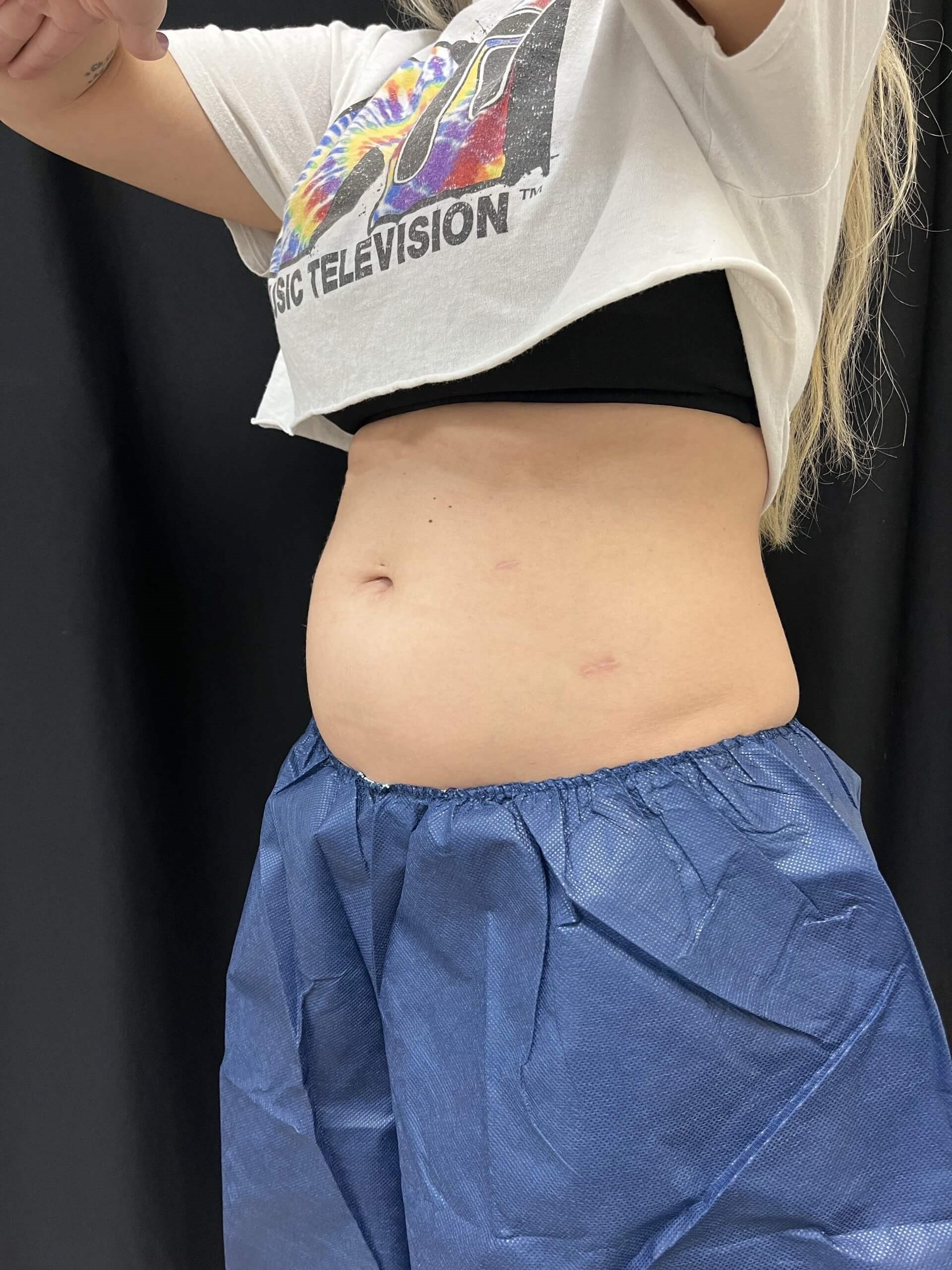 Coolsculpting Abdomen Before