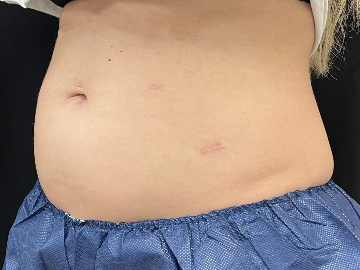 Coolsculpting Abdomen Before