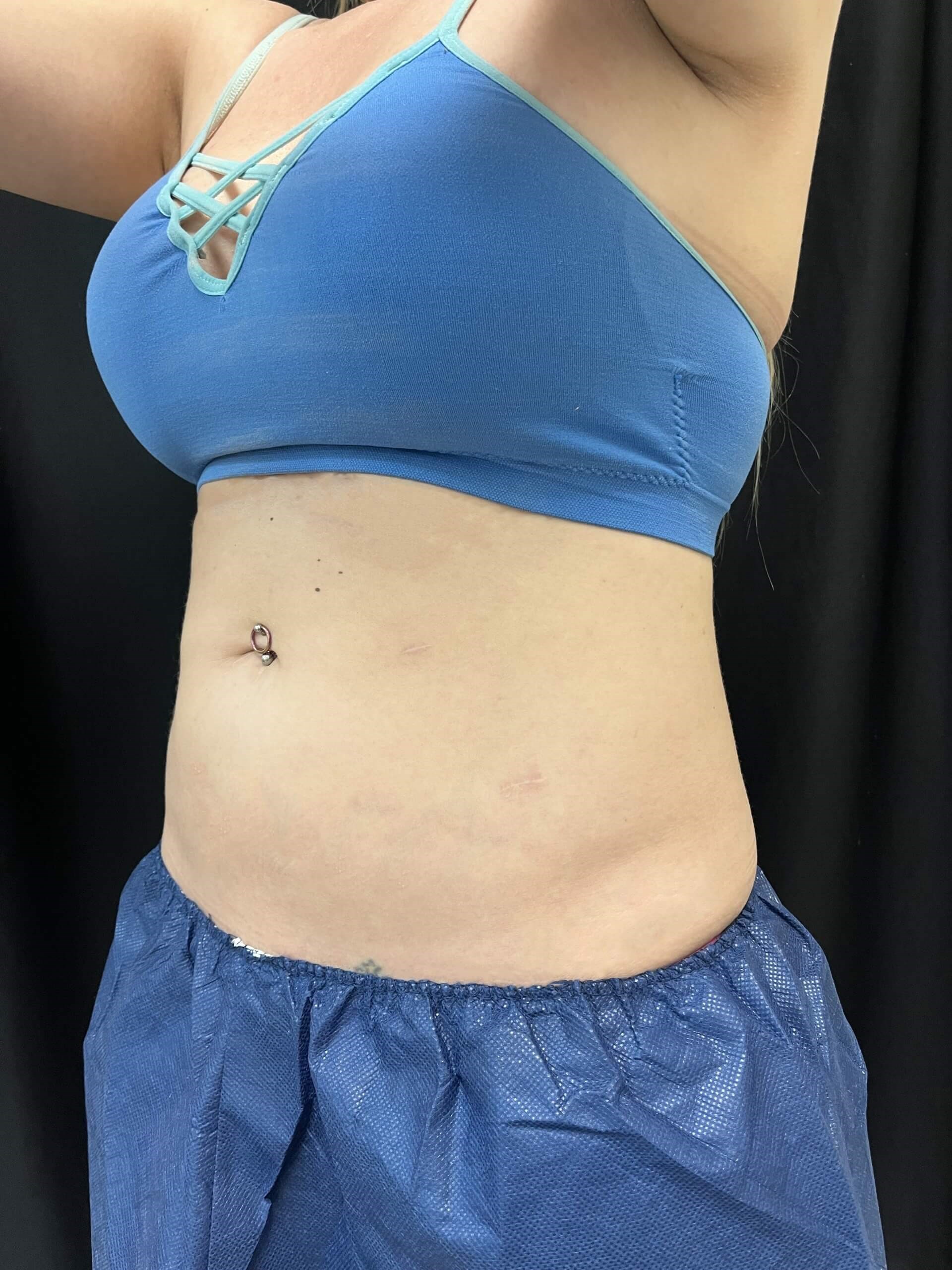 Coolsculpting Abdomen 3 months after treatment