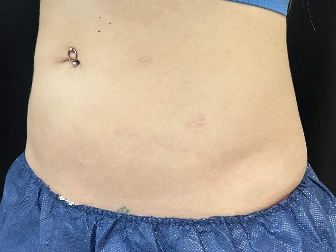 Coolsculpting Abdomen 3 months after treatment
