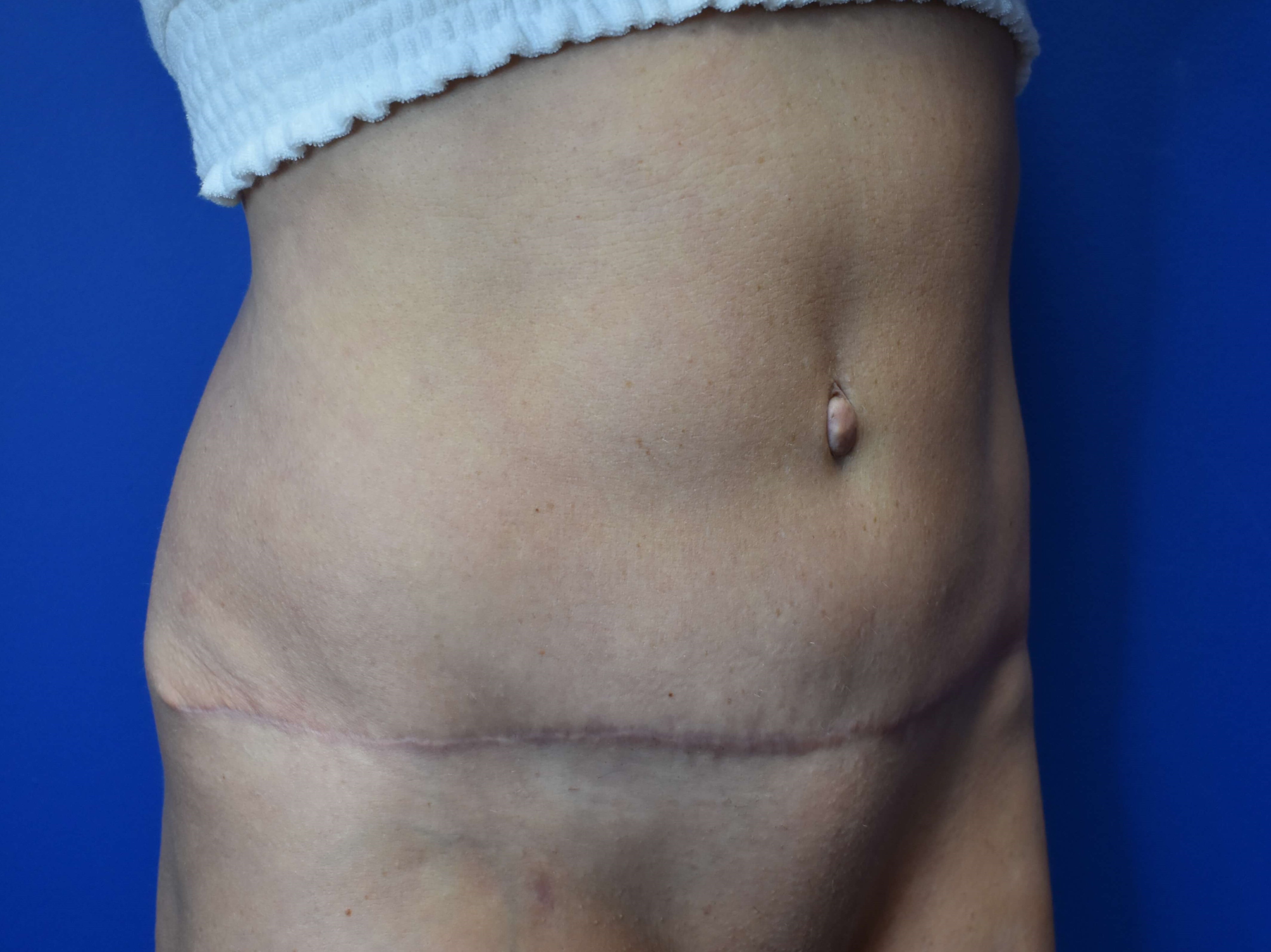Right After Tummy Tuck