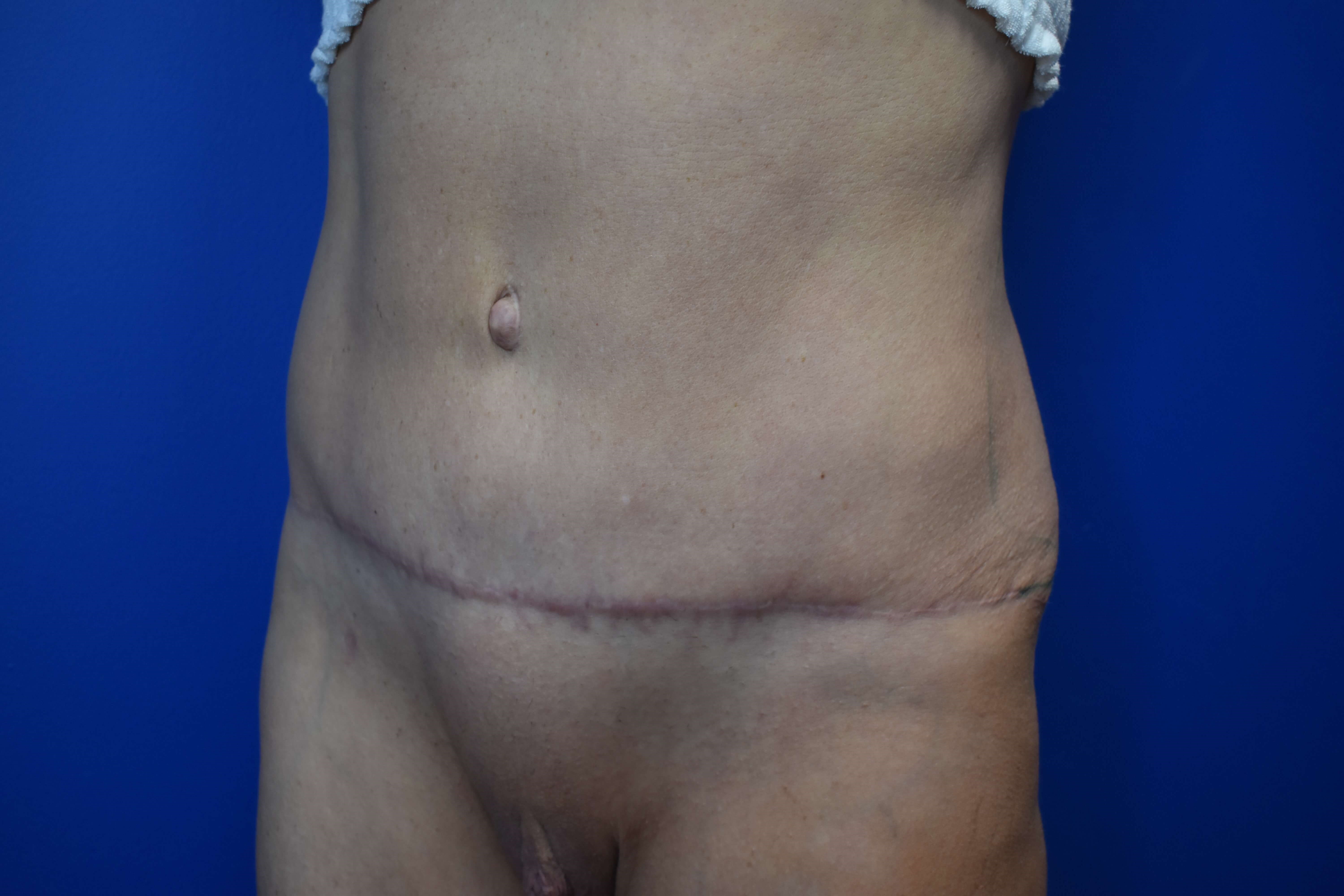 Left After Tummy Tuck