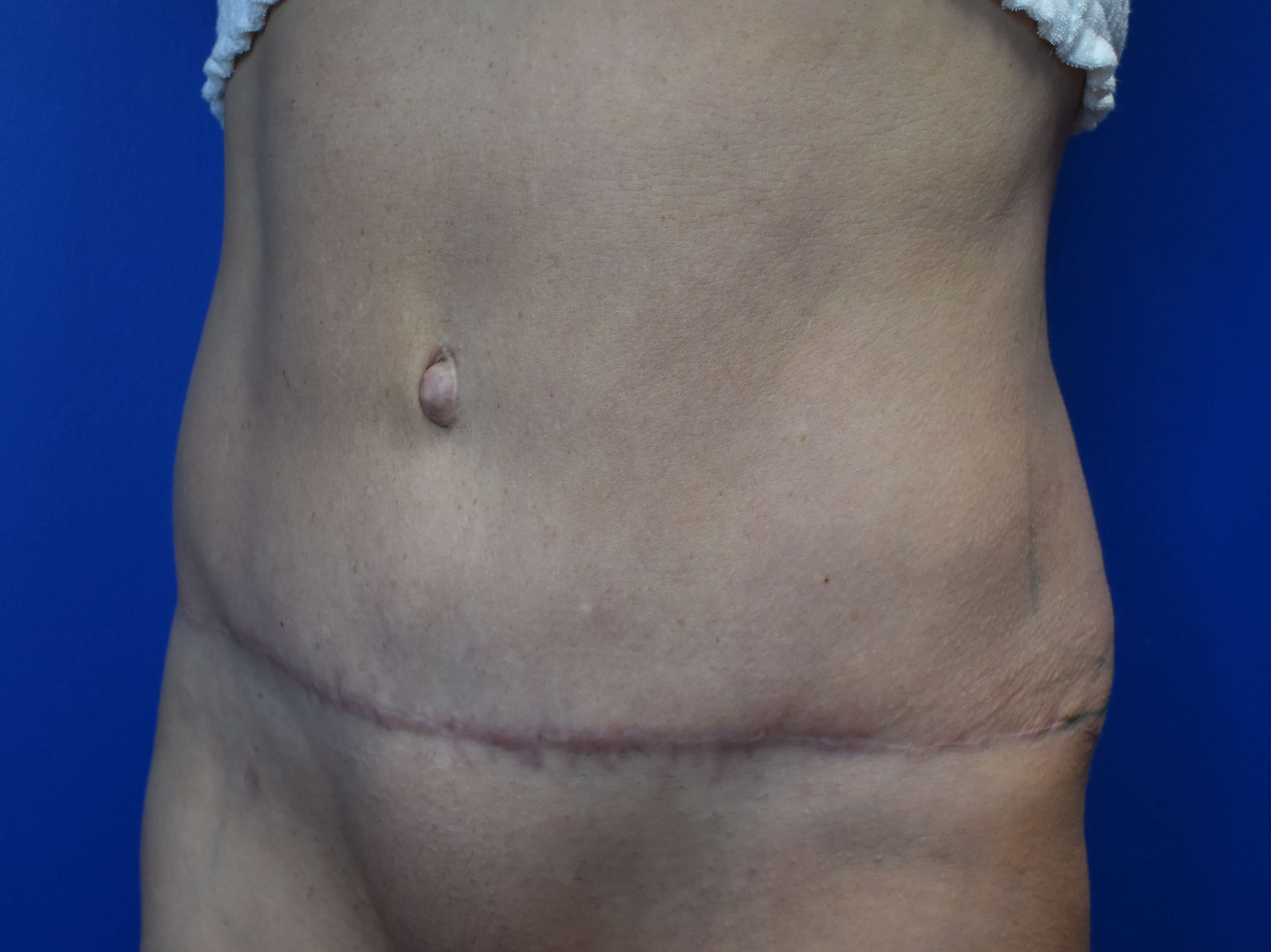 Left After Tummy Tuck