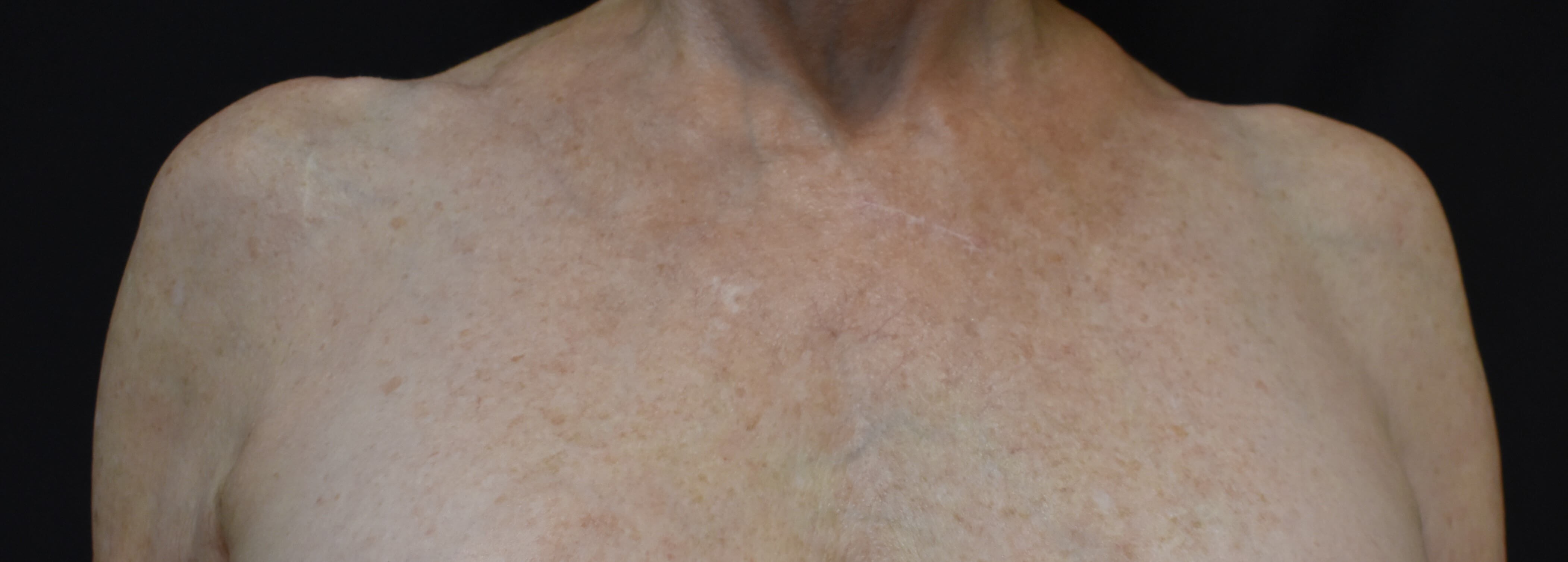 BBL HERO Before and After After
