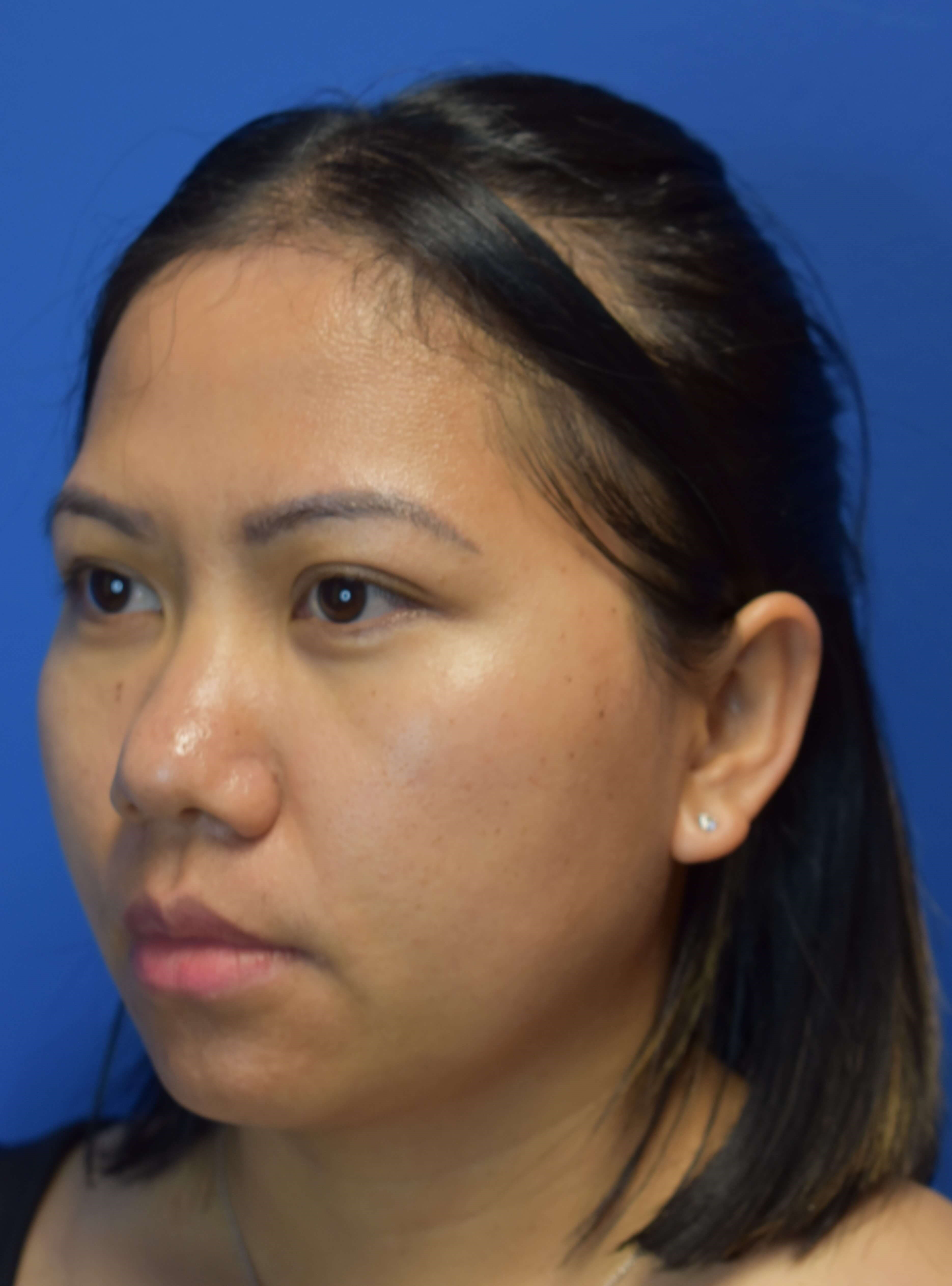 Moxi laser before and after Before