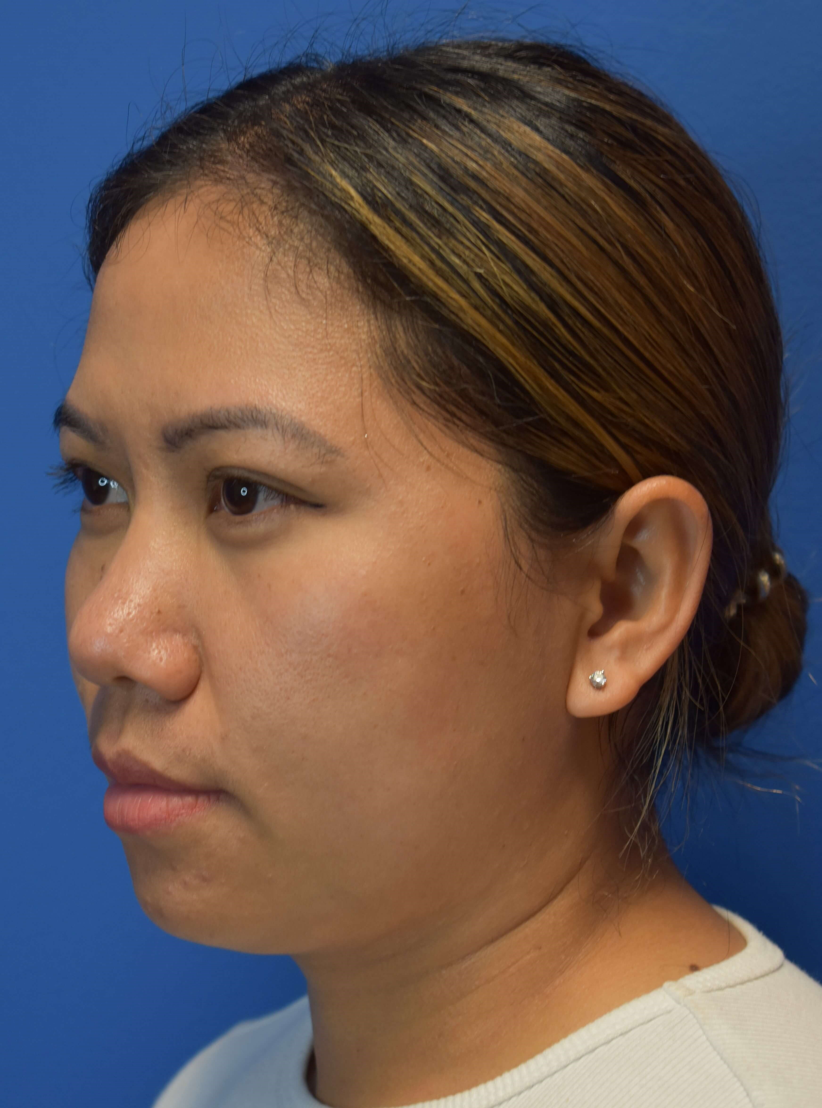 Moxi laser before and after After