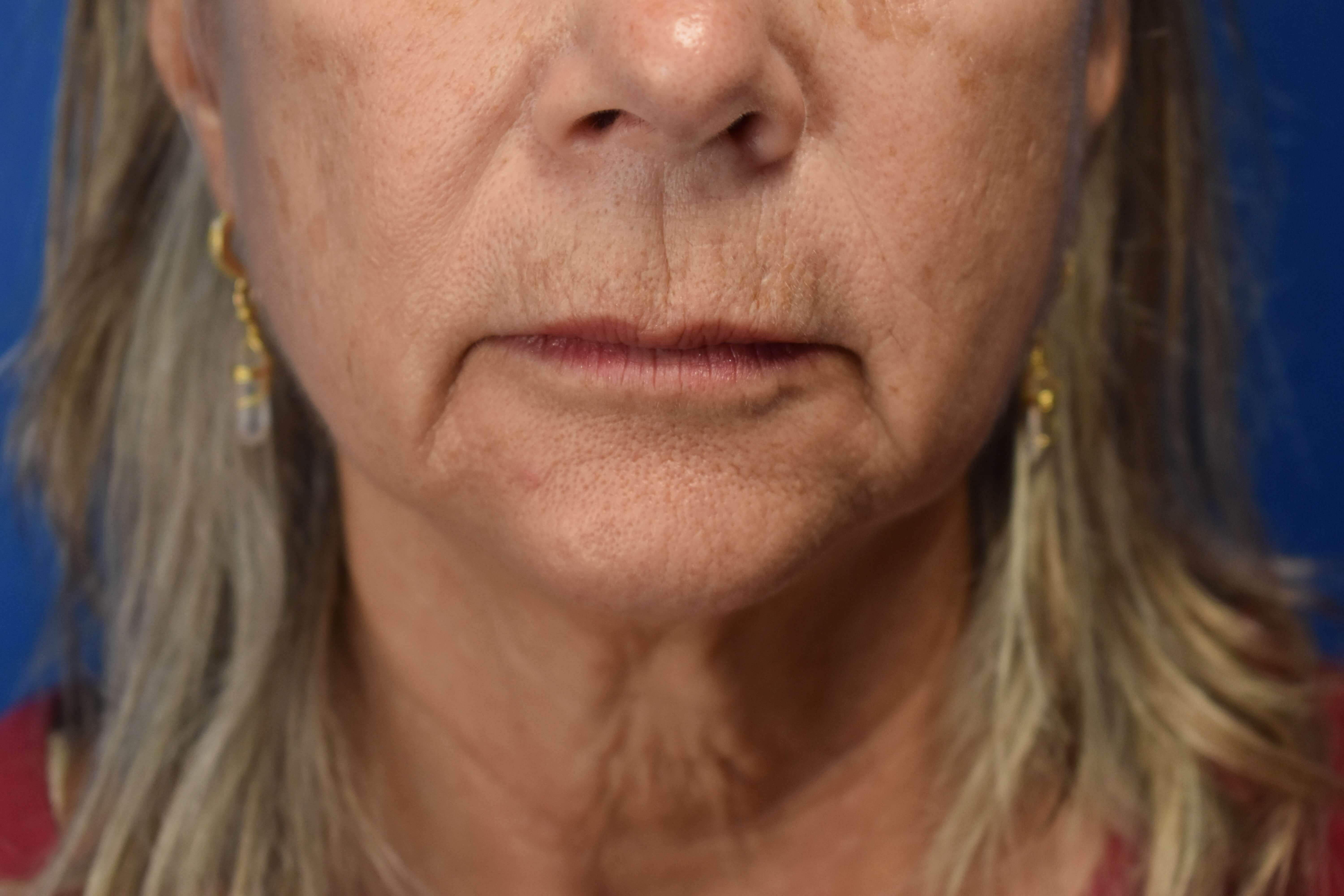 Upper Lip Wrinkle Correction Before