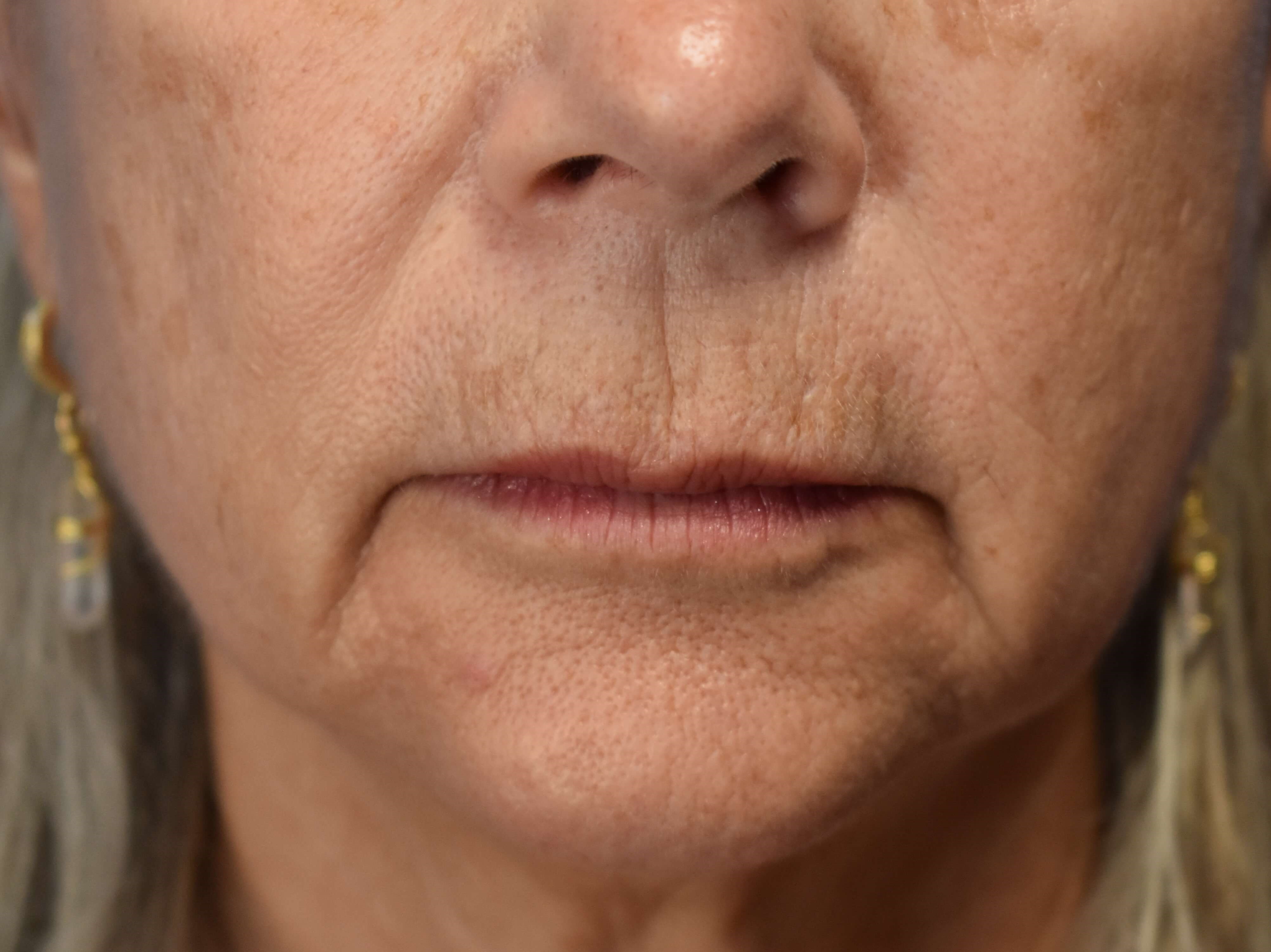 Upper Lip Wrinkle Correction Before