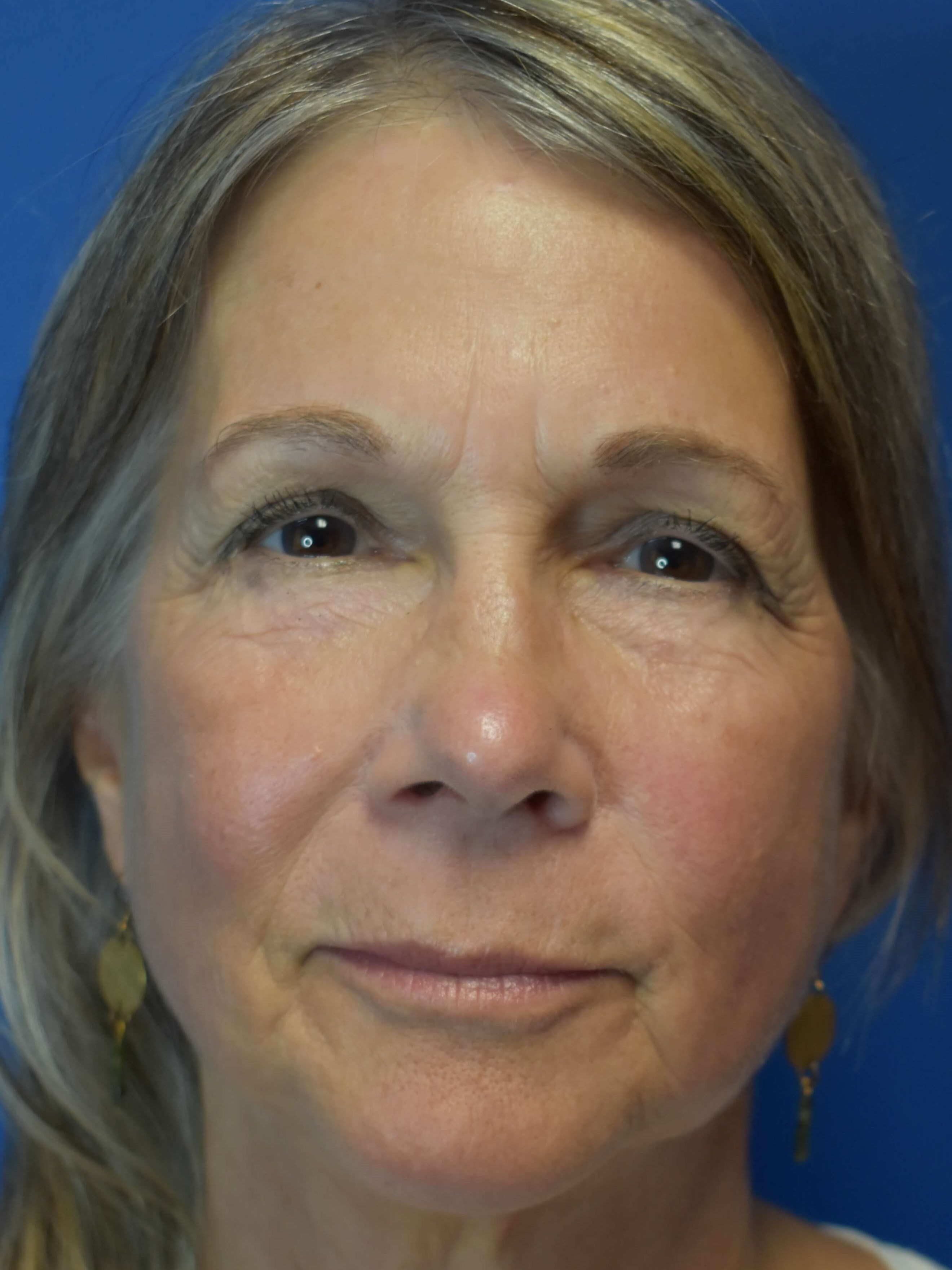 Contour TRL Laser- Front View After