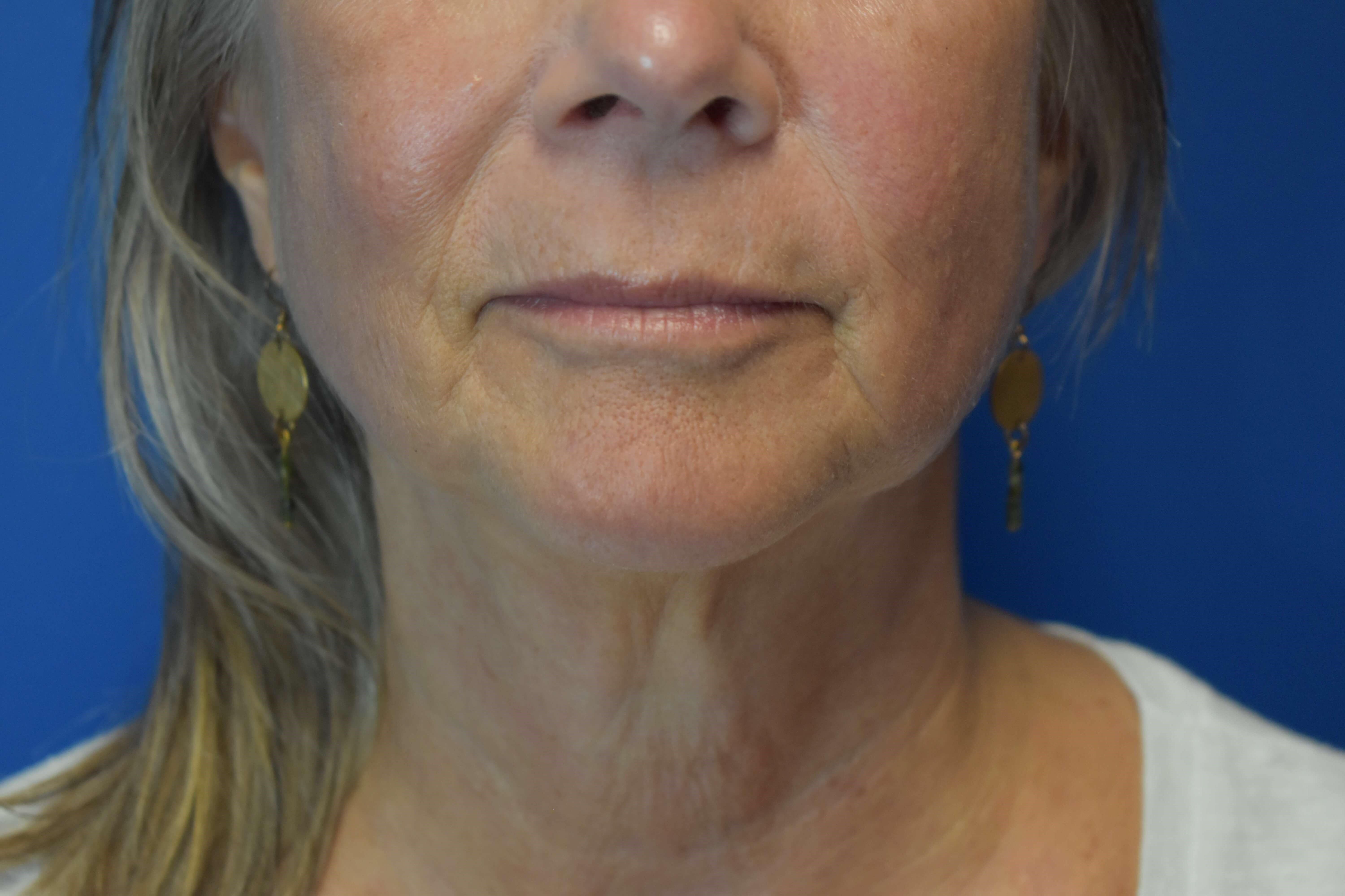 Upper Lip Wrinkle Correction After