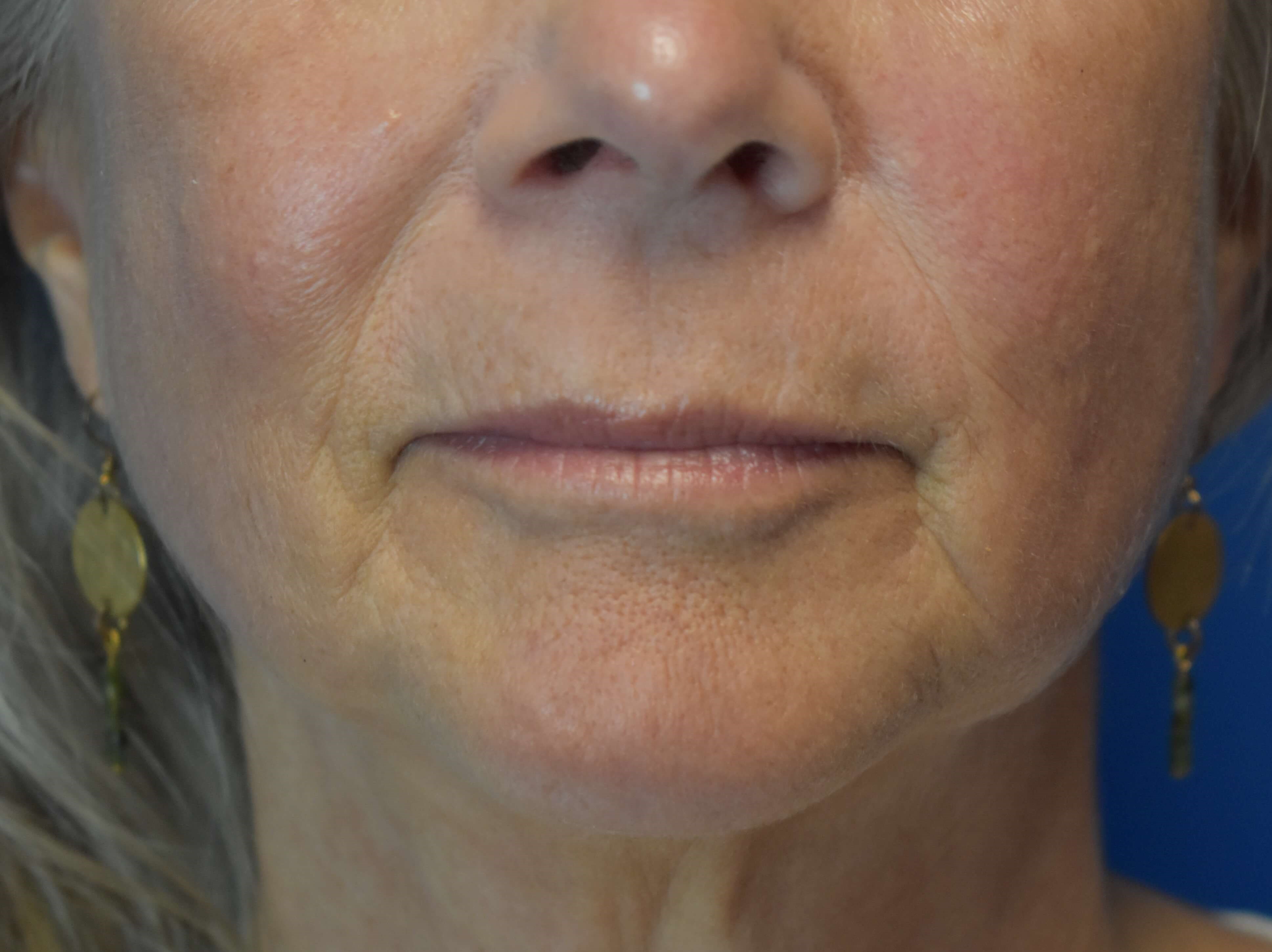 Upper Lip Wrinkle Correction After