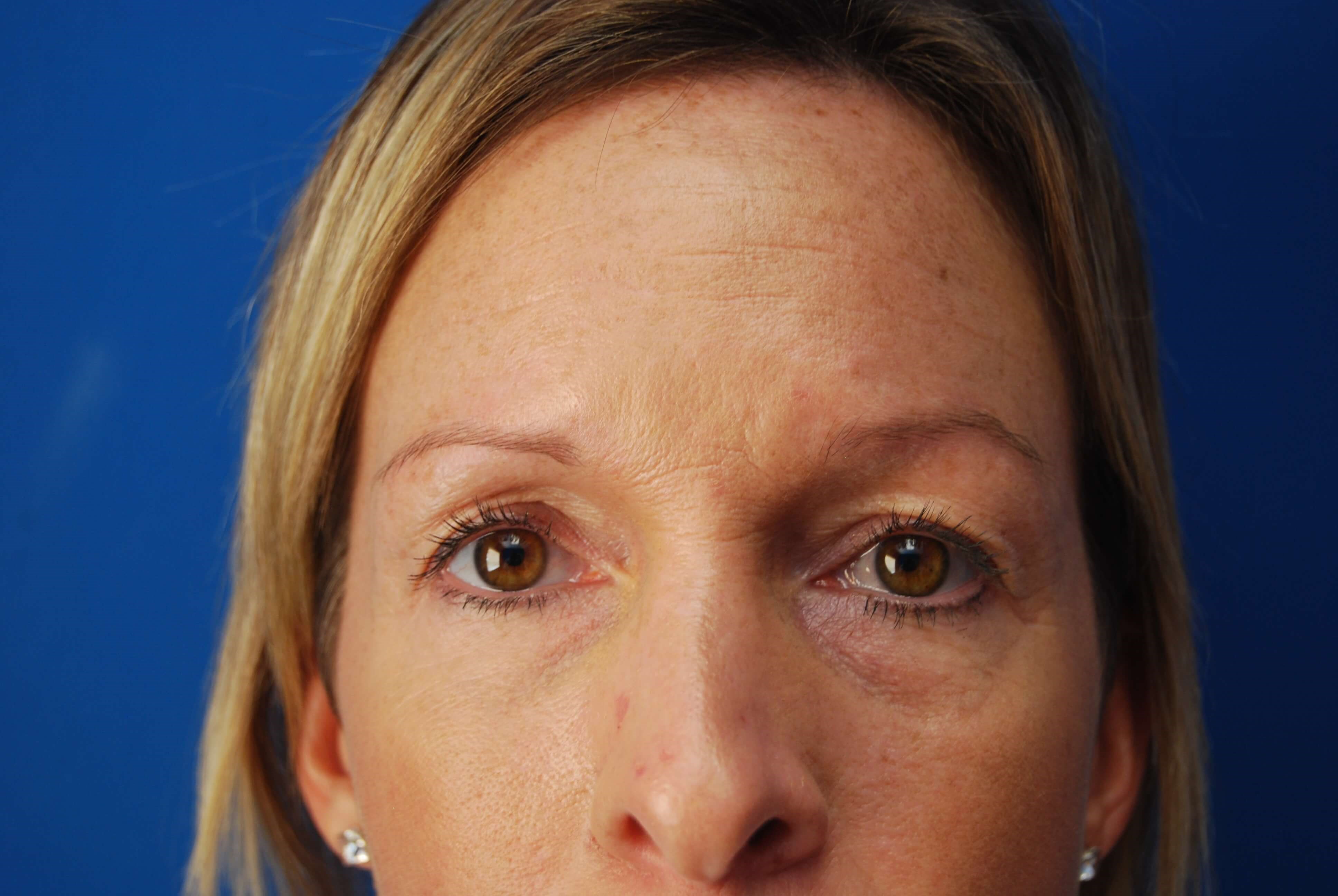 Upper and Lower Eyelid Lift Before