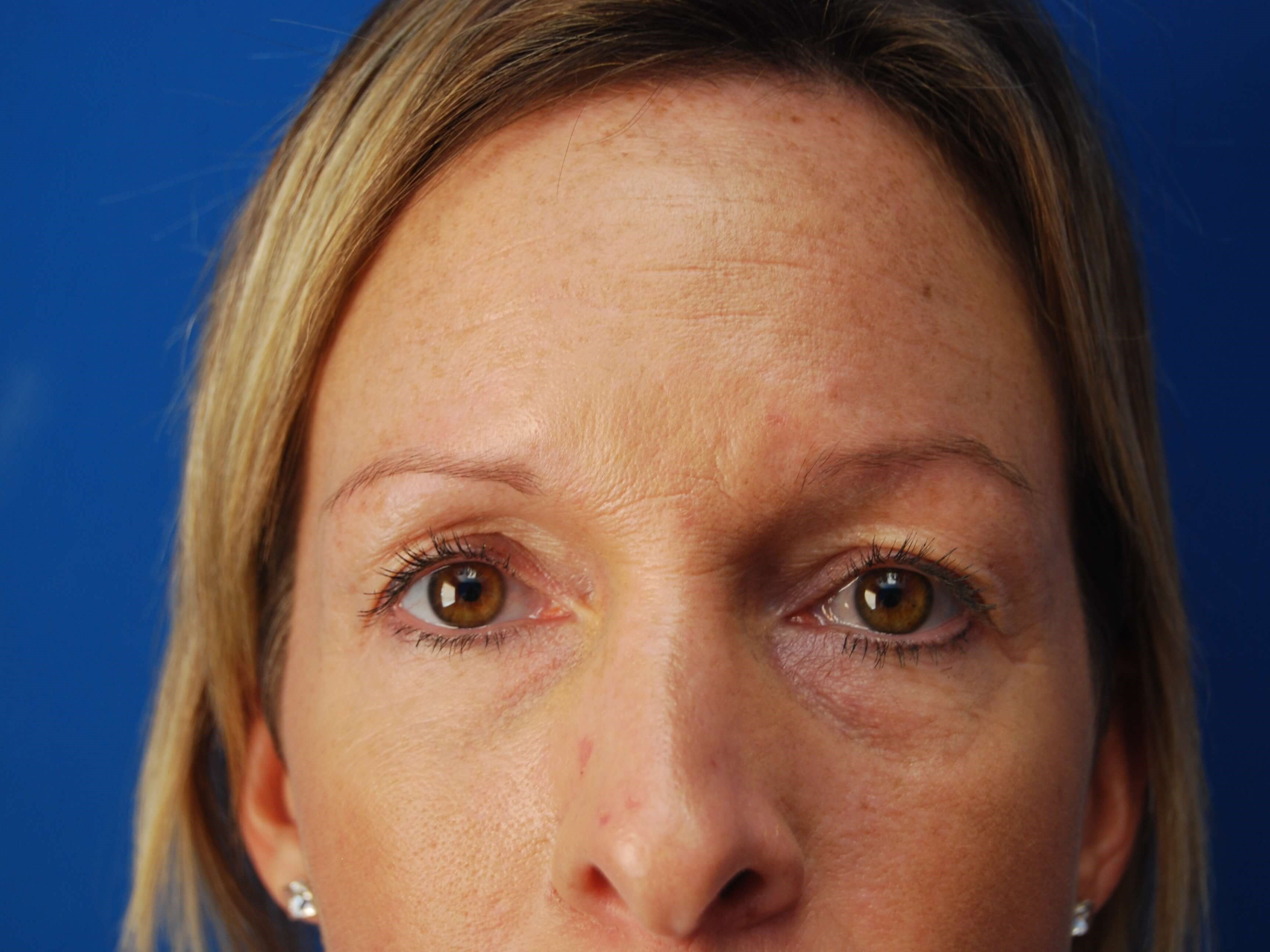 Upper and Lower Eyelid Lift Before