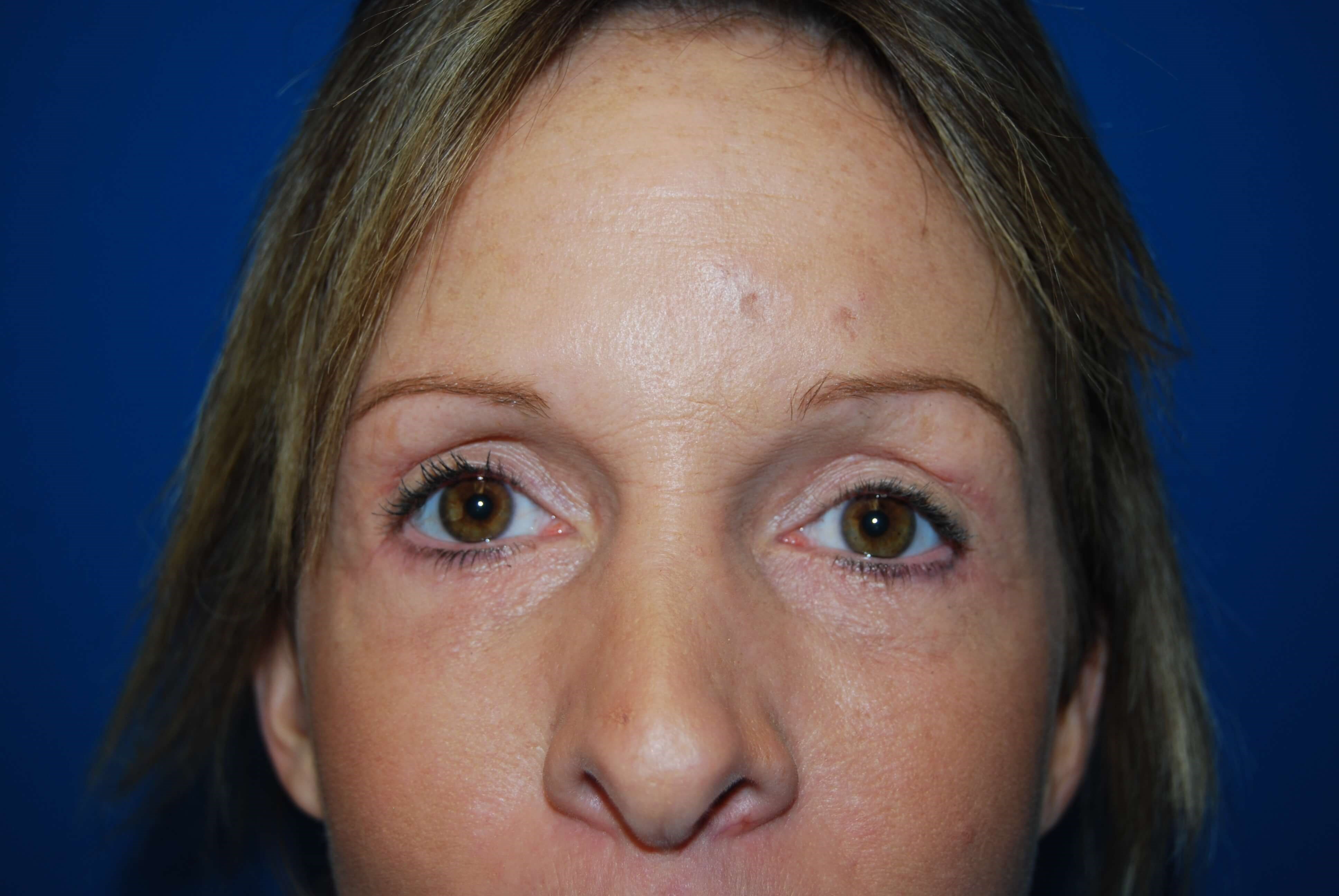 Upper and Lower Eyelid Lift After