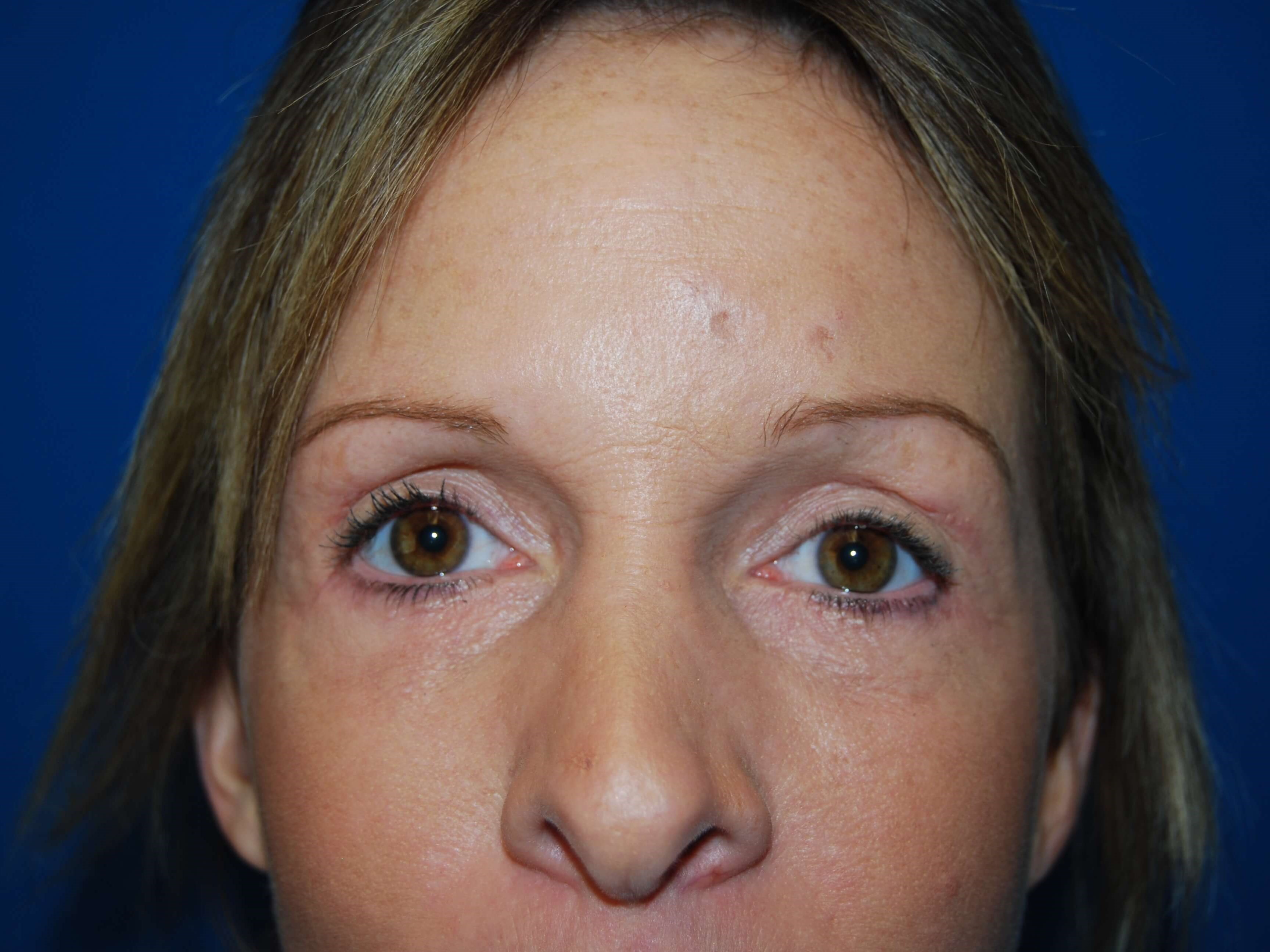 Upper and Lower Eyelid Lift After