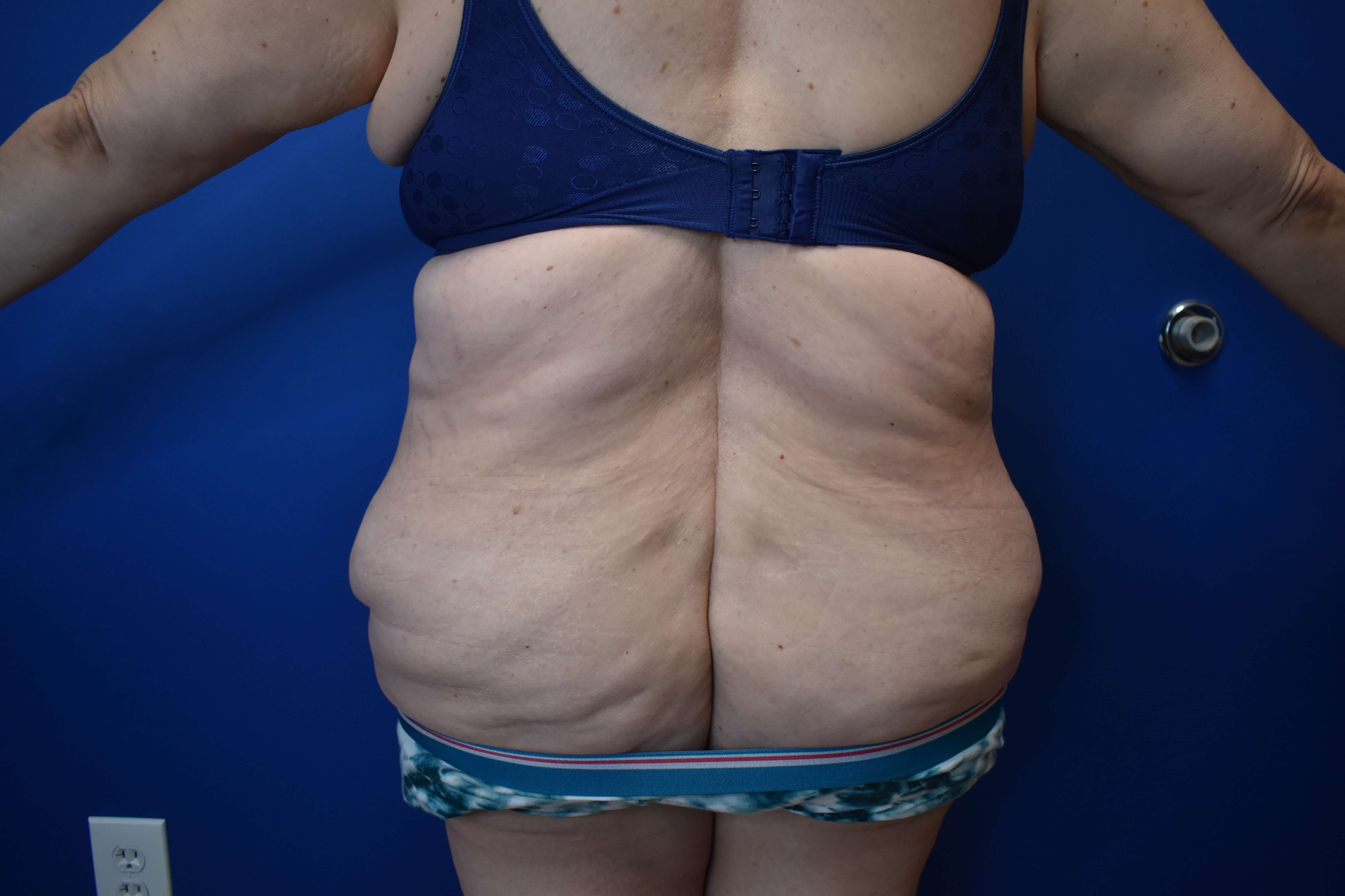 Tummy Tuck and Belt Lipectomy Before