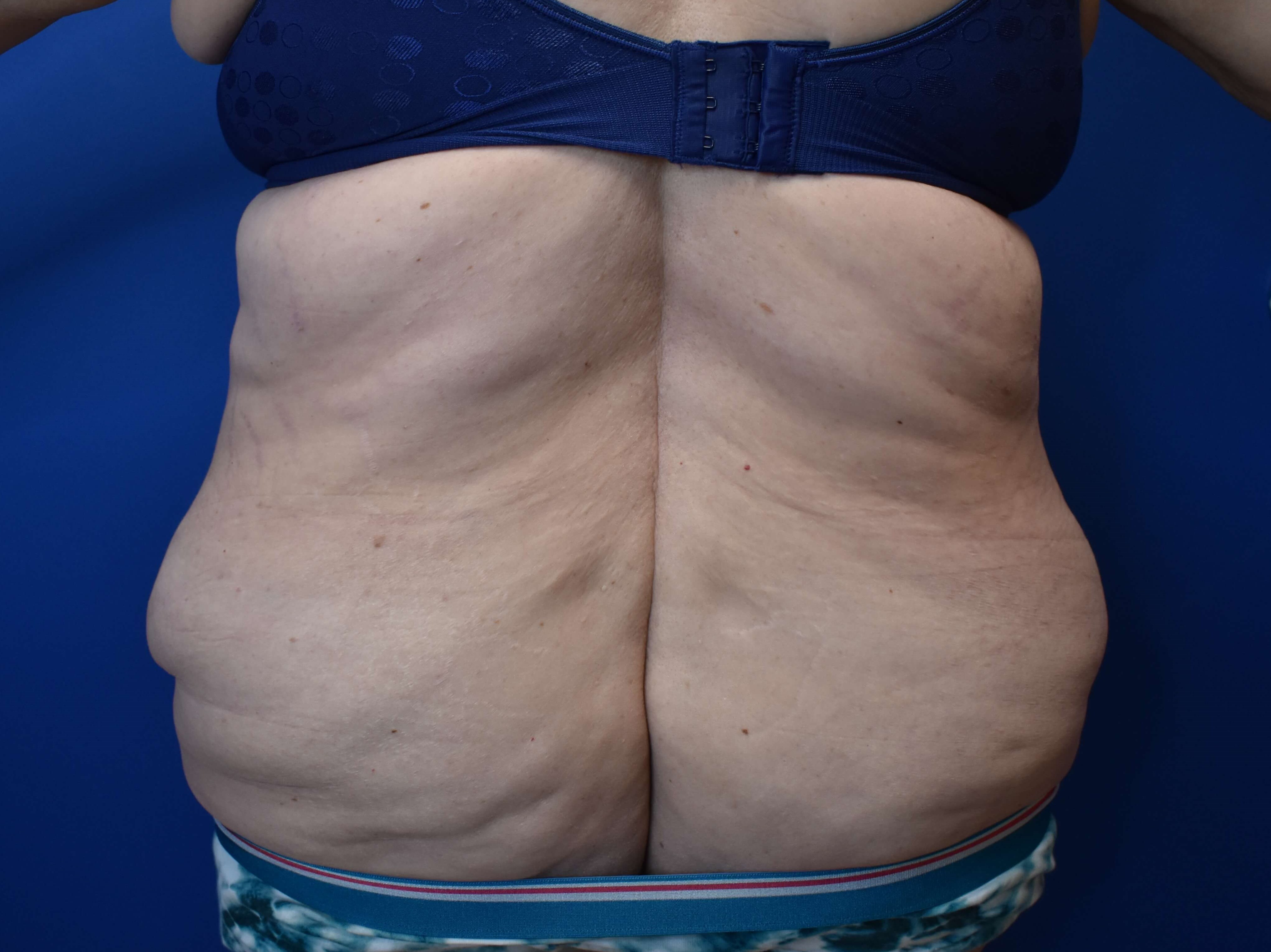Tummy Tuck and Belt Lipectomy Before