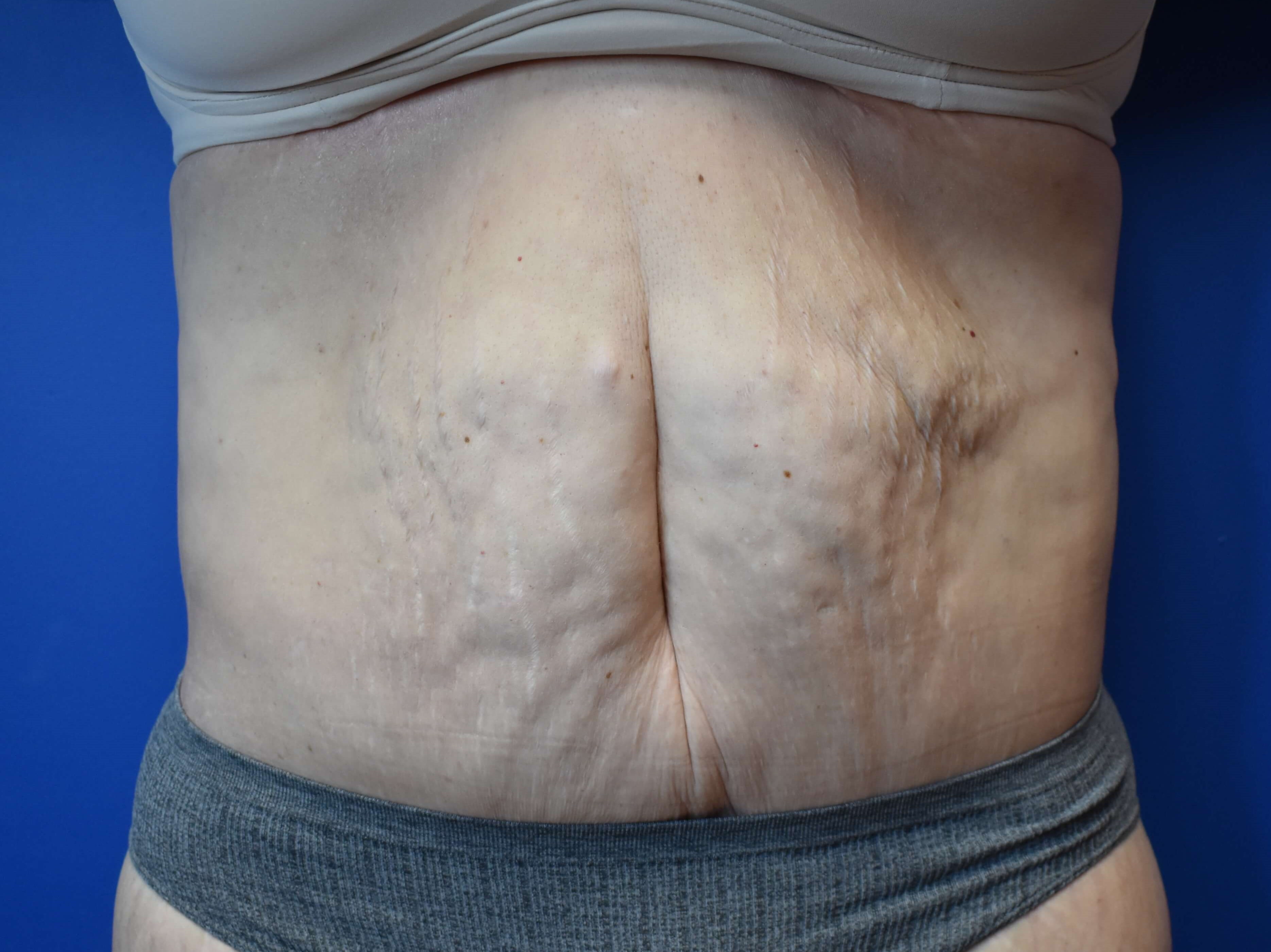 Tummy Tuck and Belt Lipectomy After