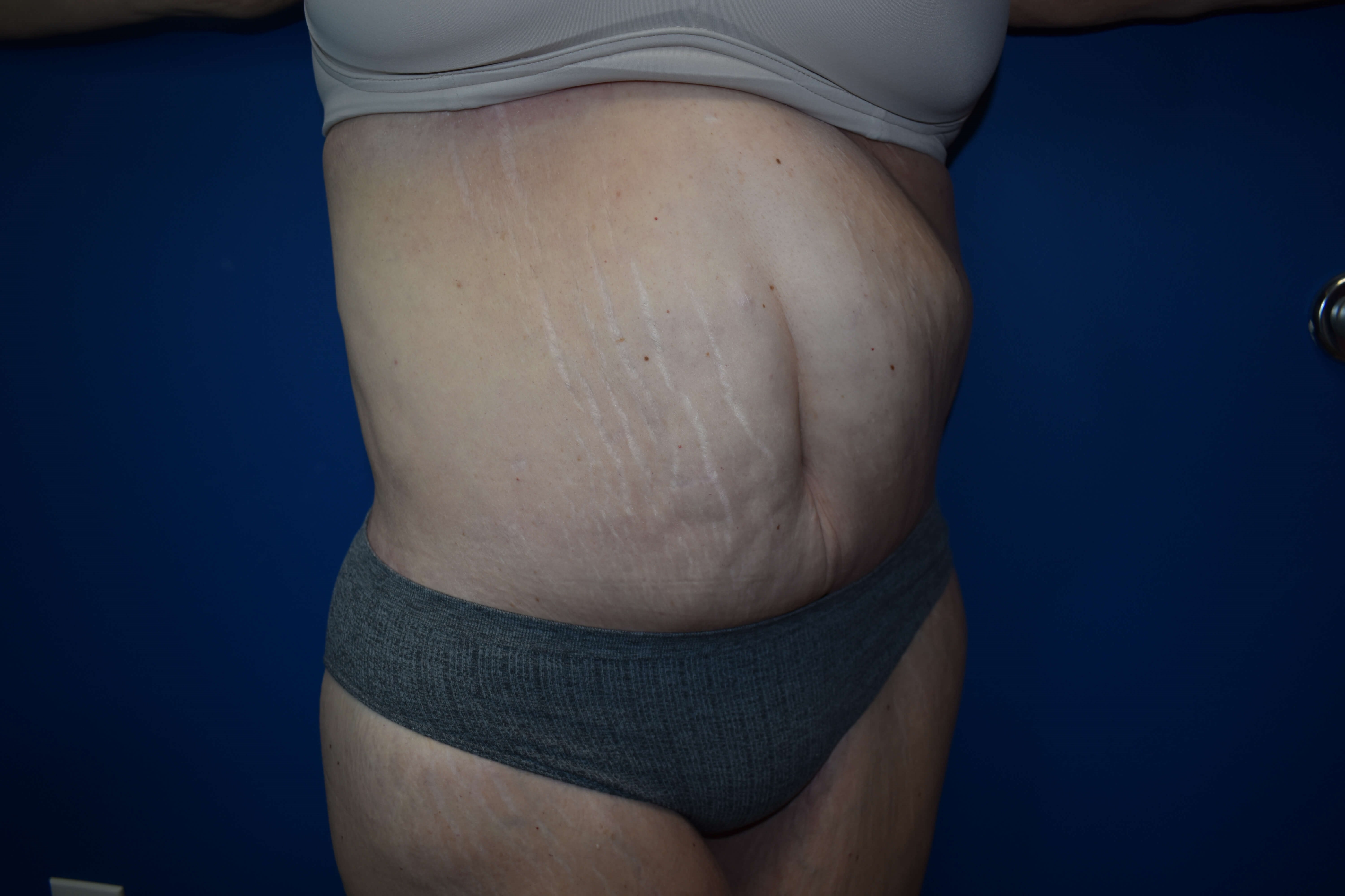 Tummy Tuck and Belt Lipectomy After