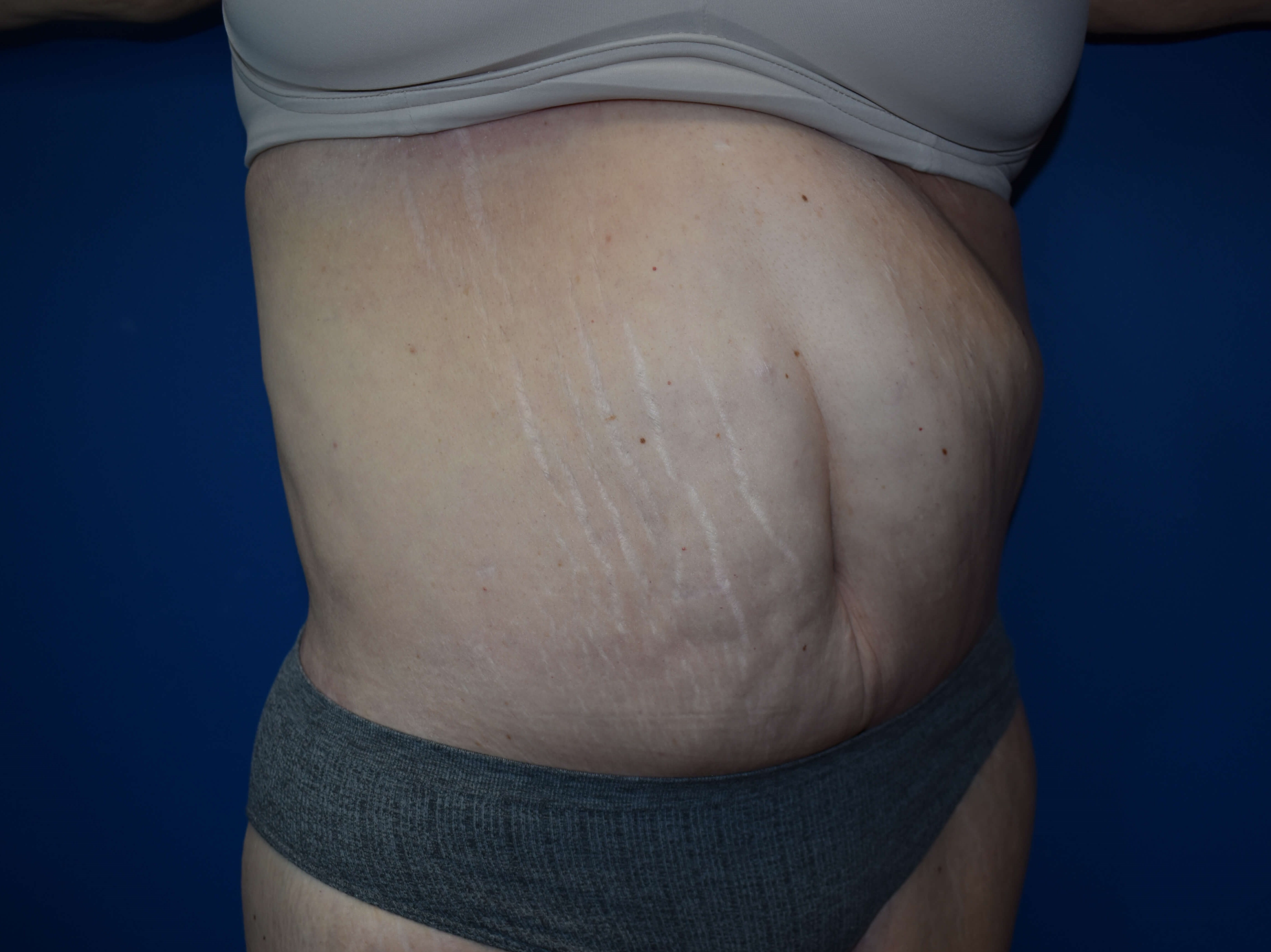 Tummy Tuck and Belt Lipectomy After