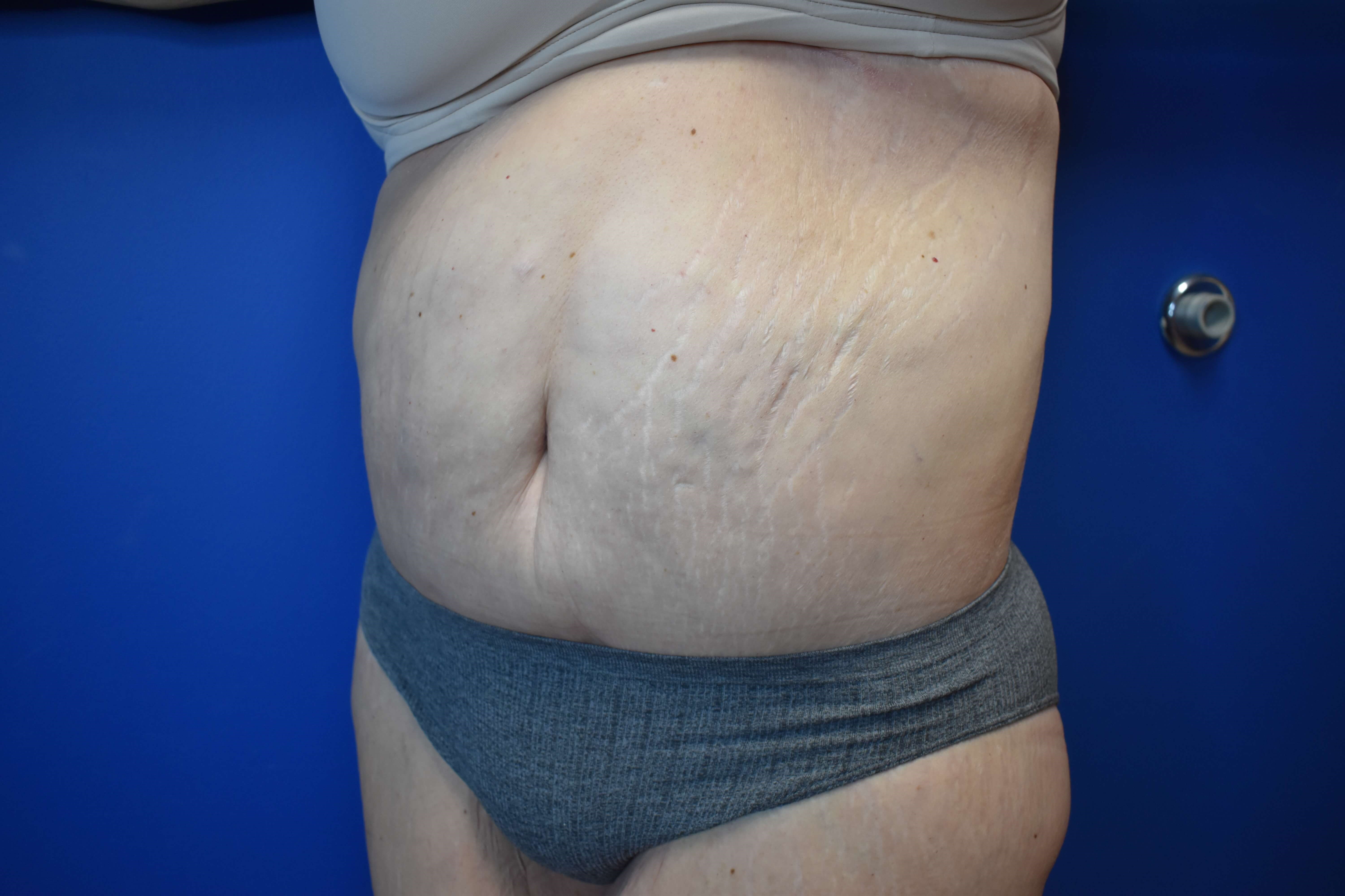 Tummy Tuck and Belt Lipectomy After