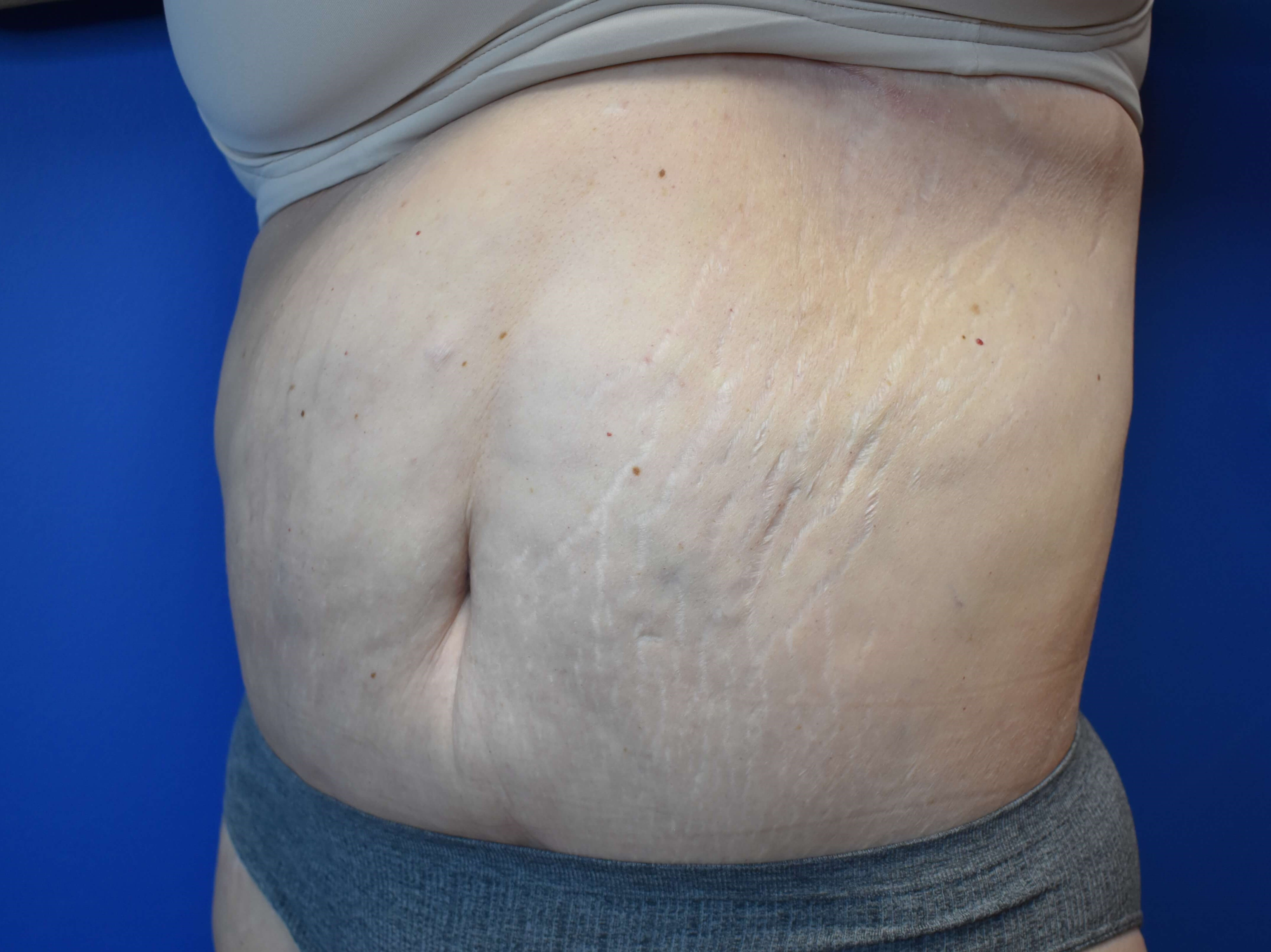 Tummy Tuck and Belt Lipectomy After
