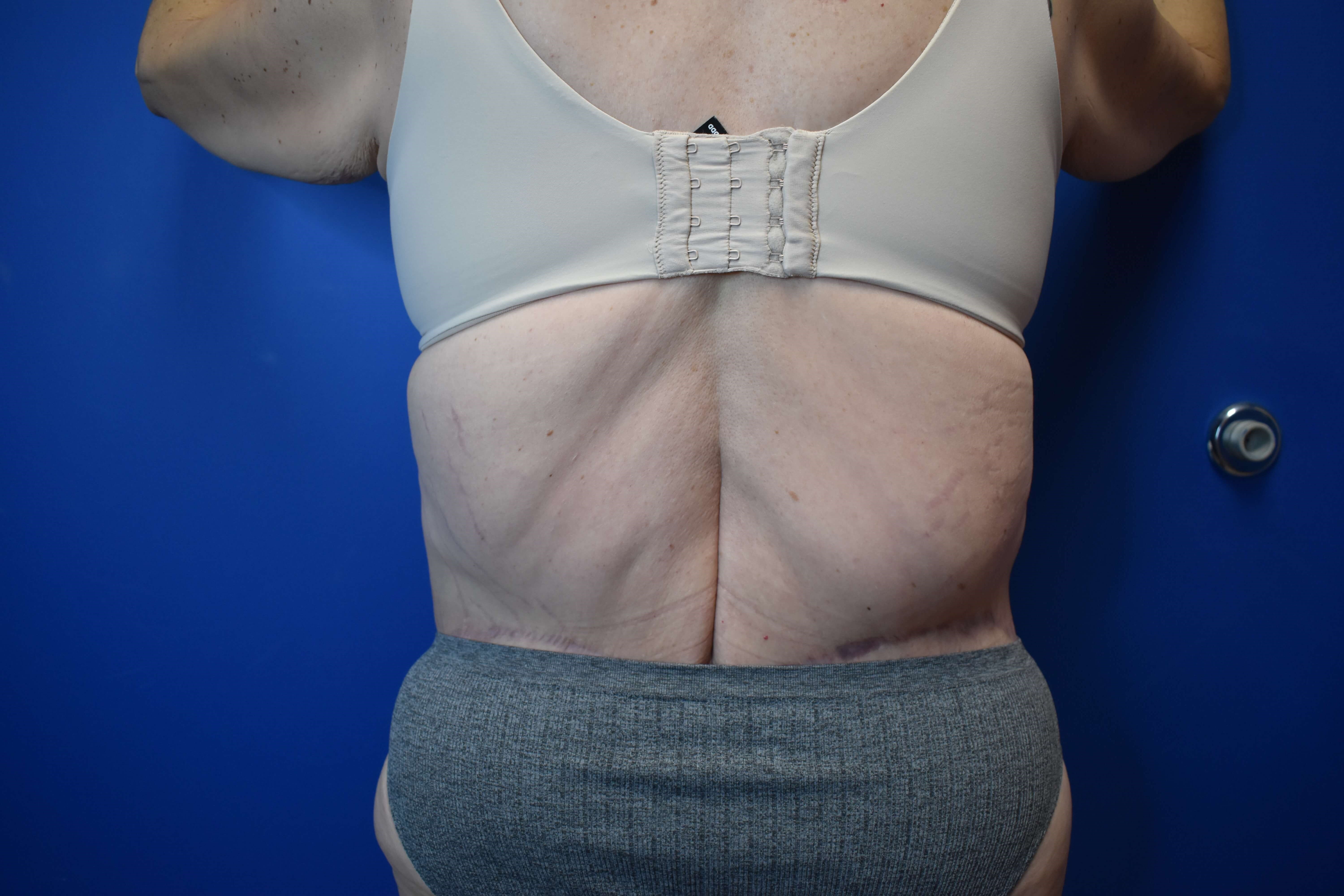 Tummy Tuck and Belt Lipectomy After