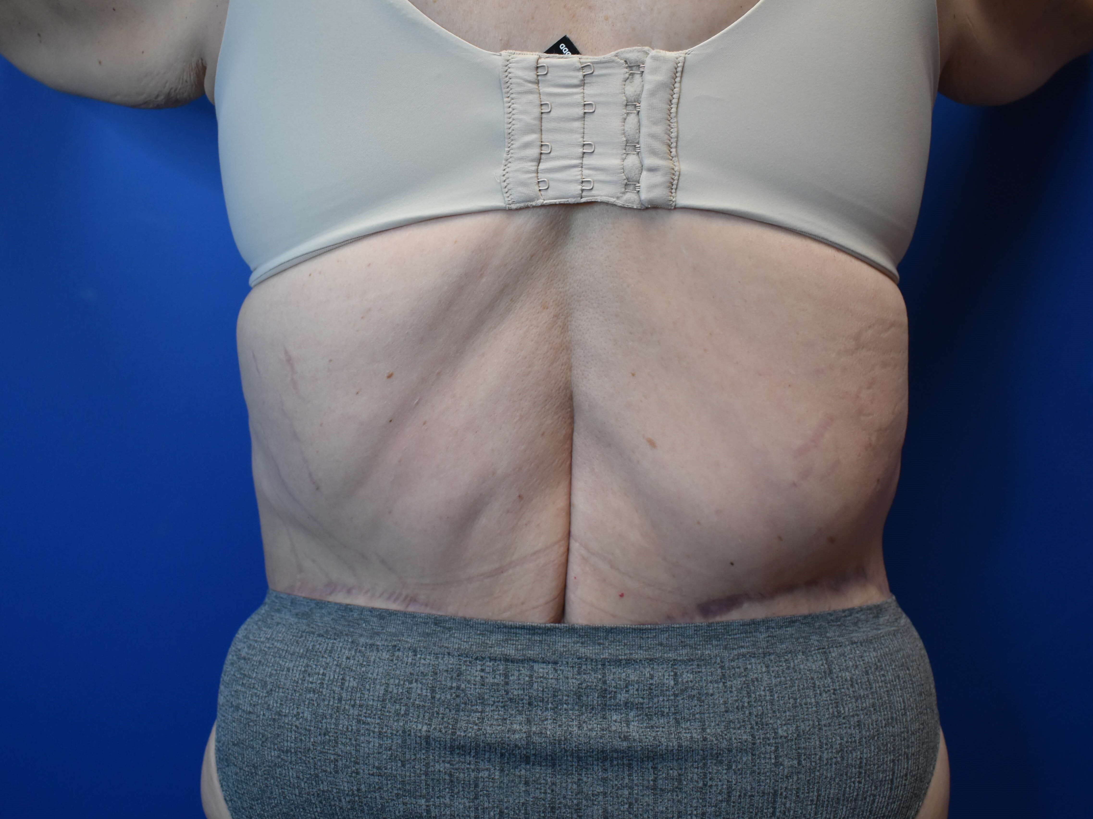Tummy Tuck and Belt Lipectomy After