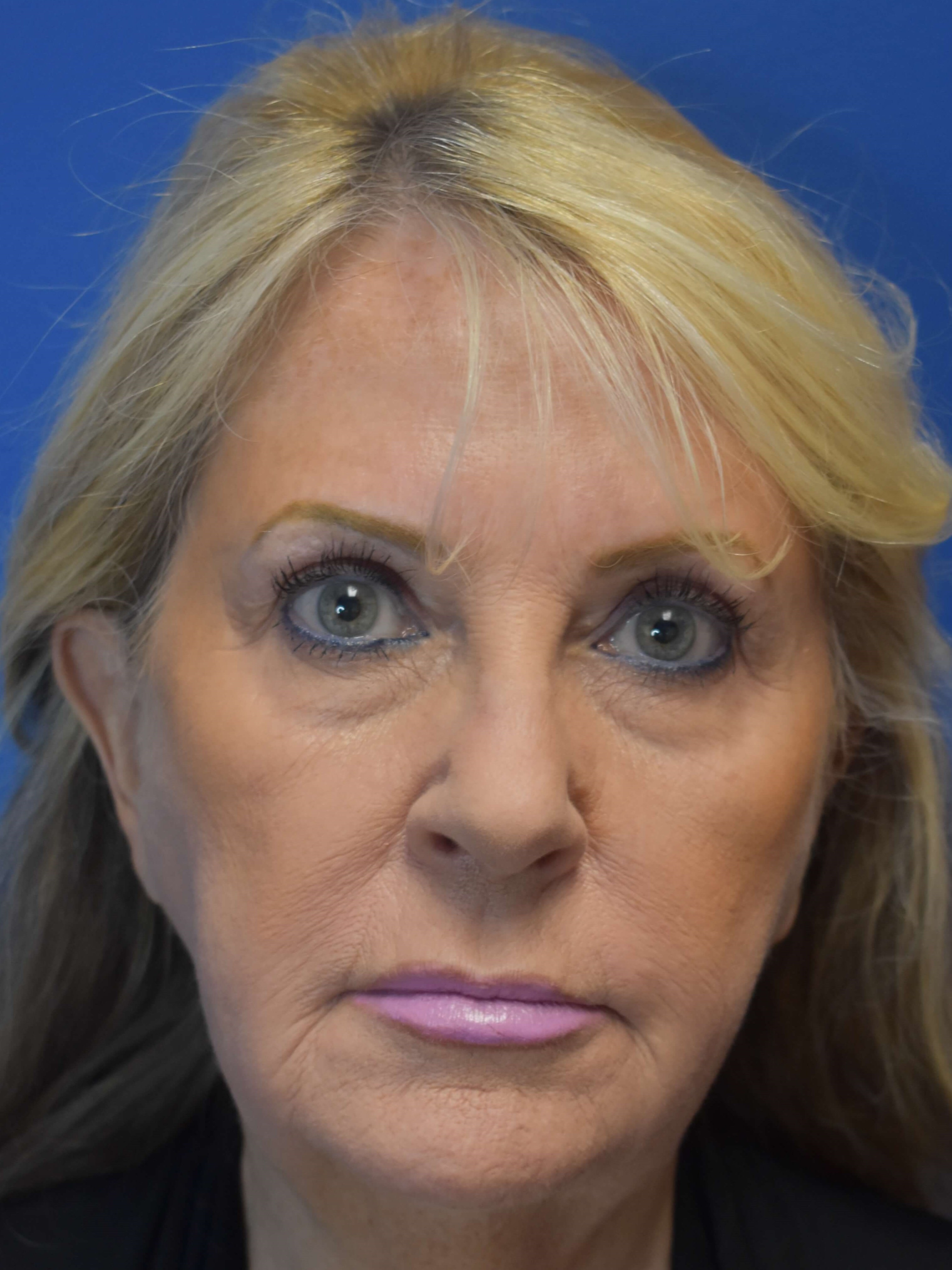 Full Face Rejuvenation Before