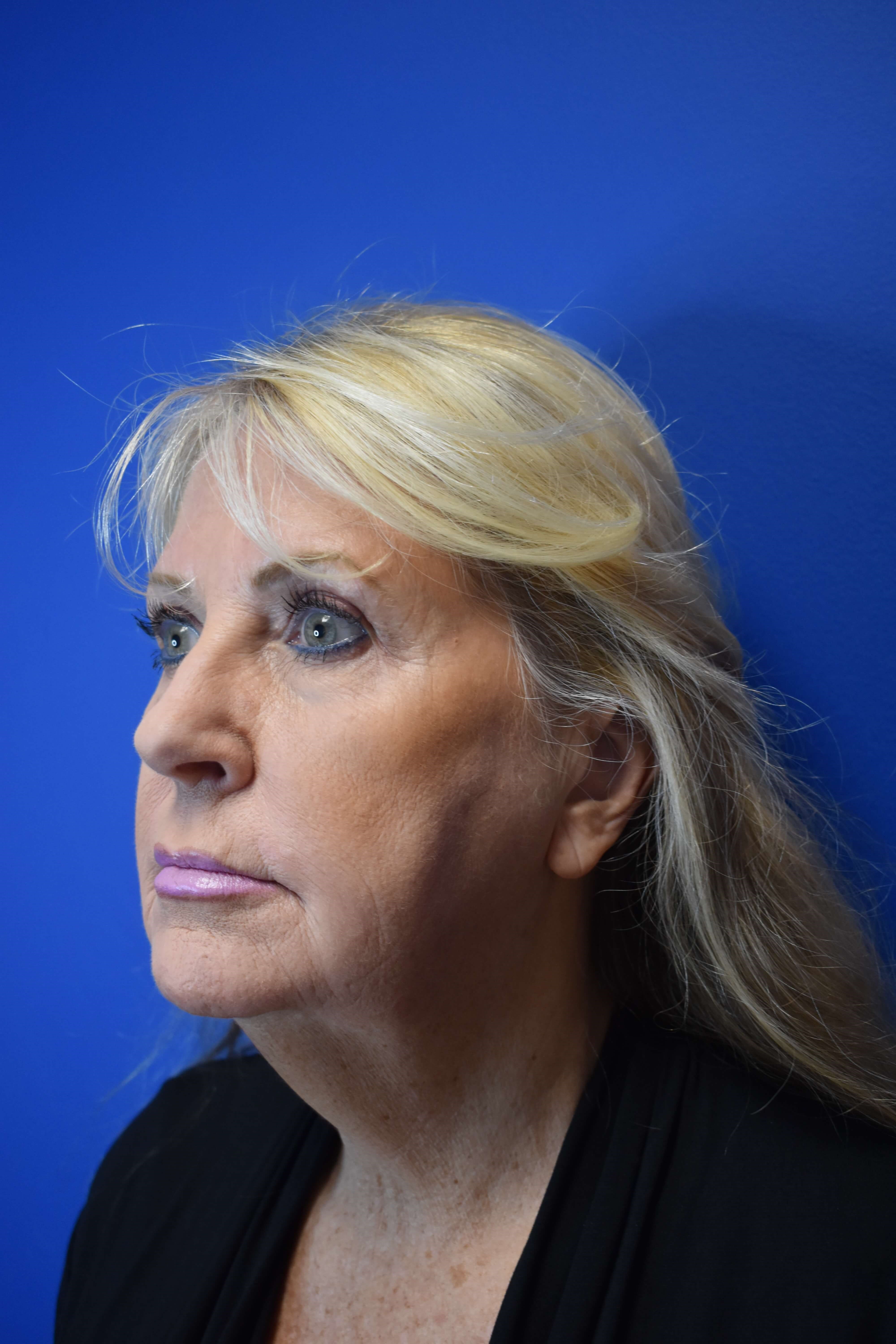 Full Face Rejuvenation Before