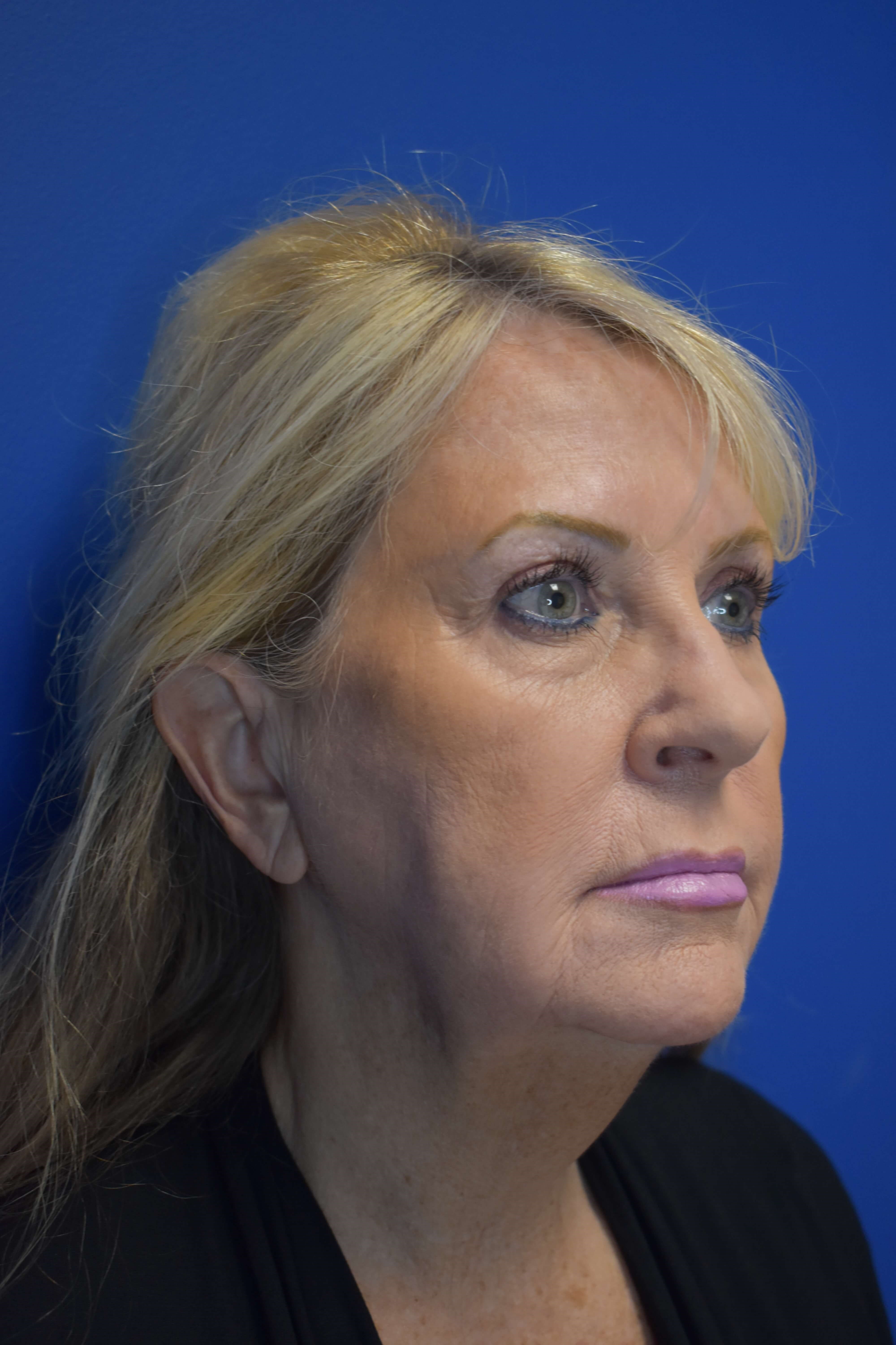 Full Face Rejuvenation Before