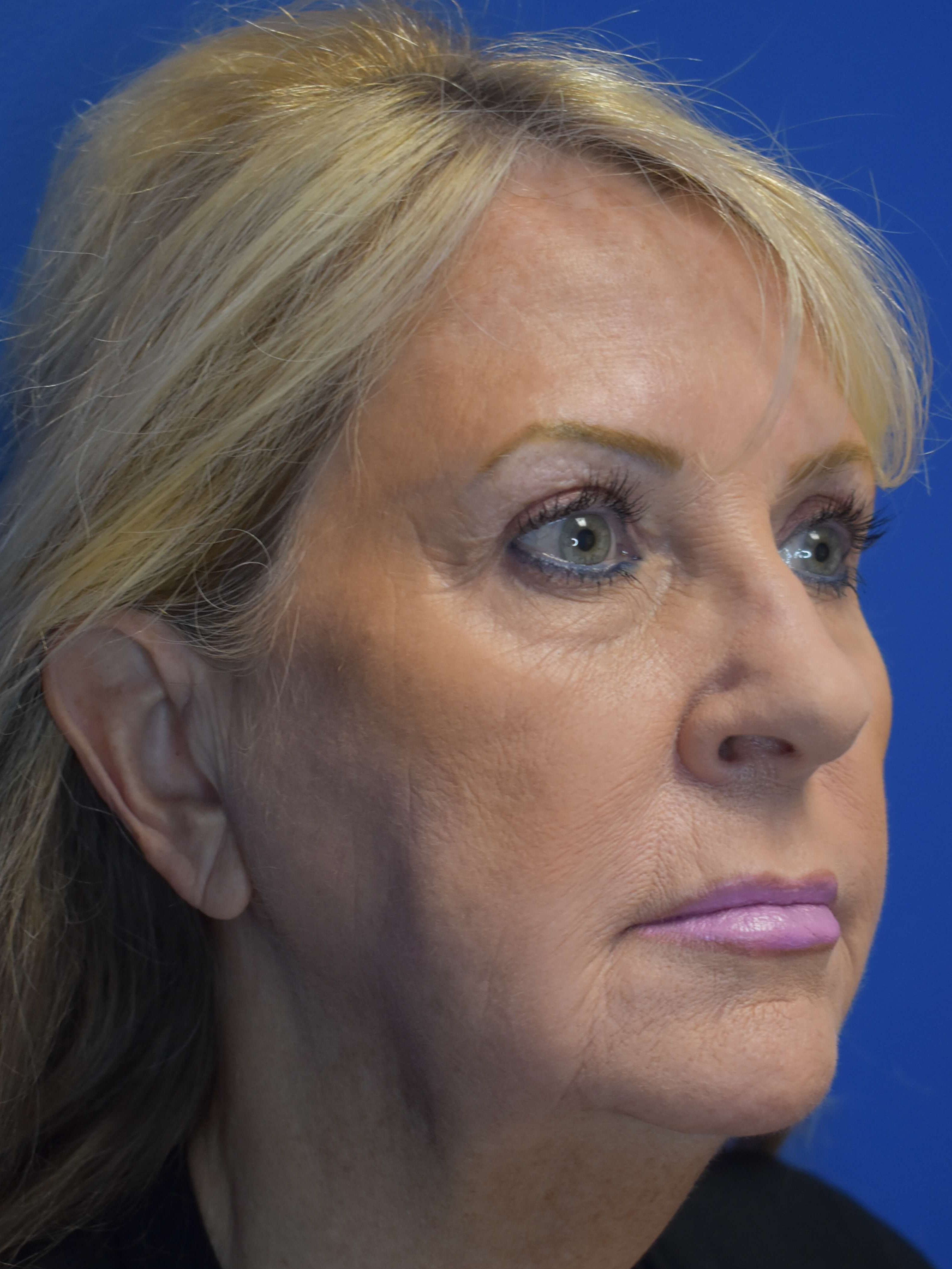 Full Face Rejuvenation Before