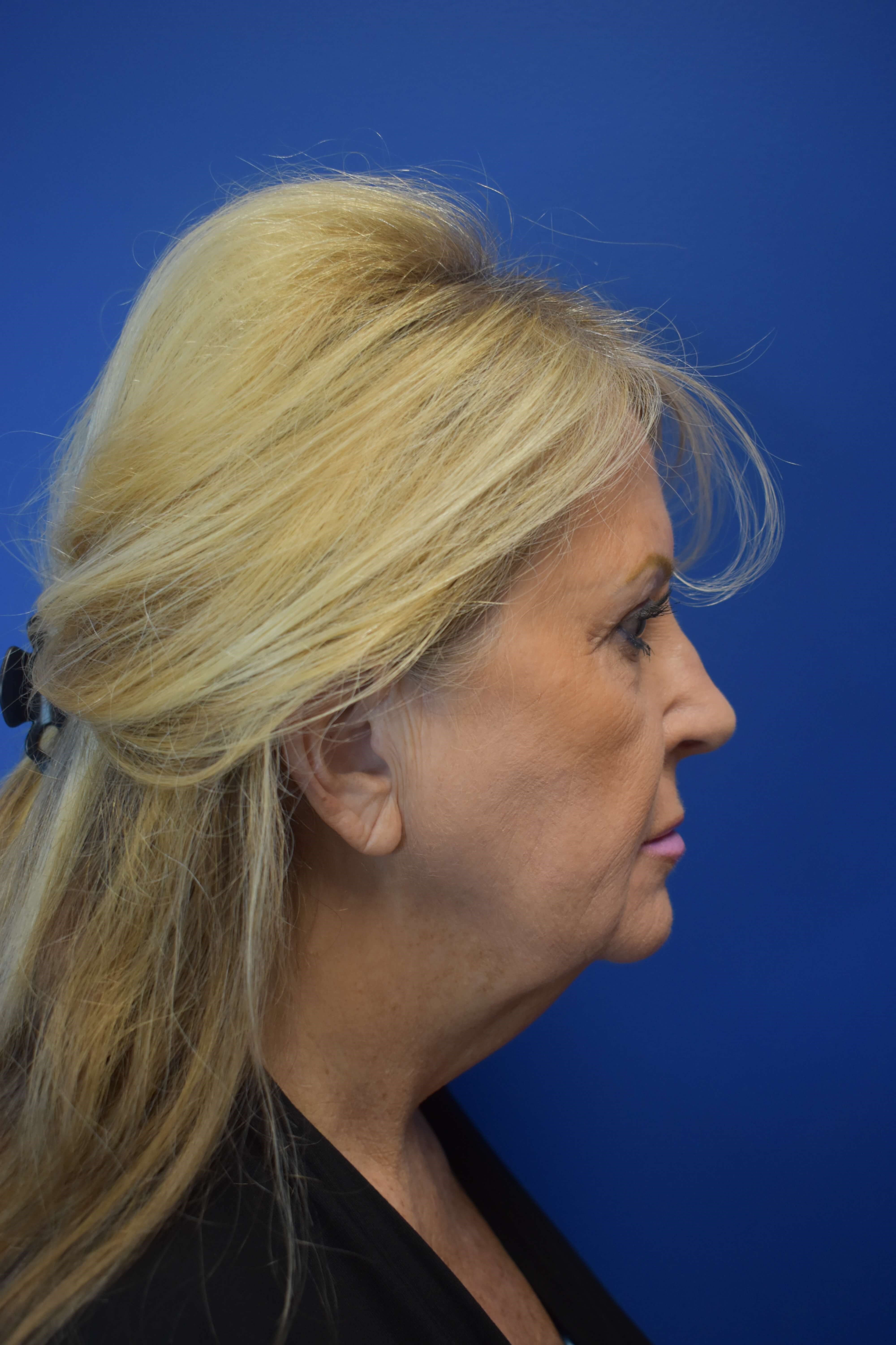Full Face Rejuvenation Before