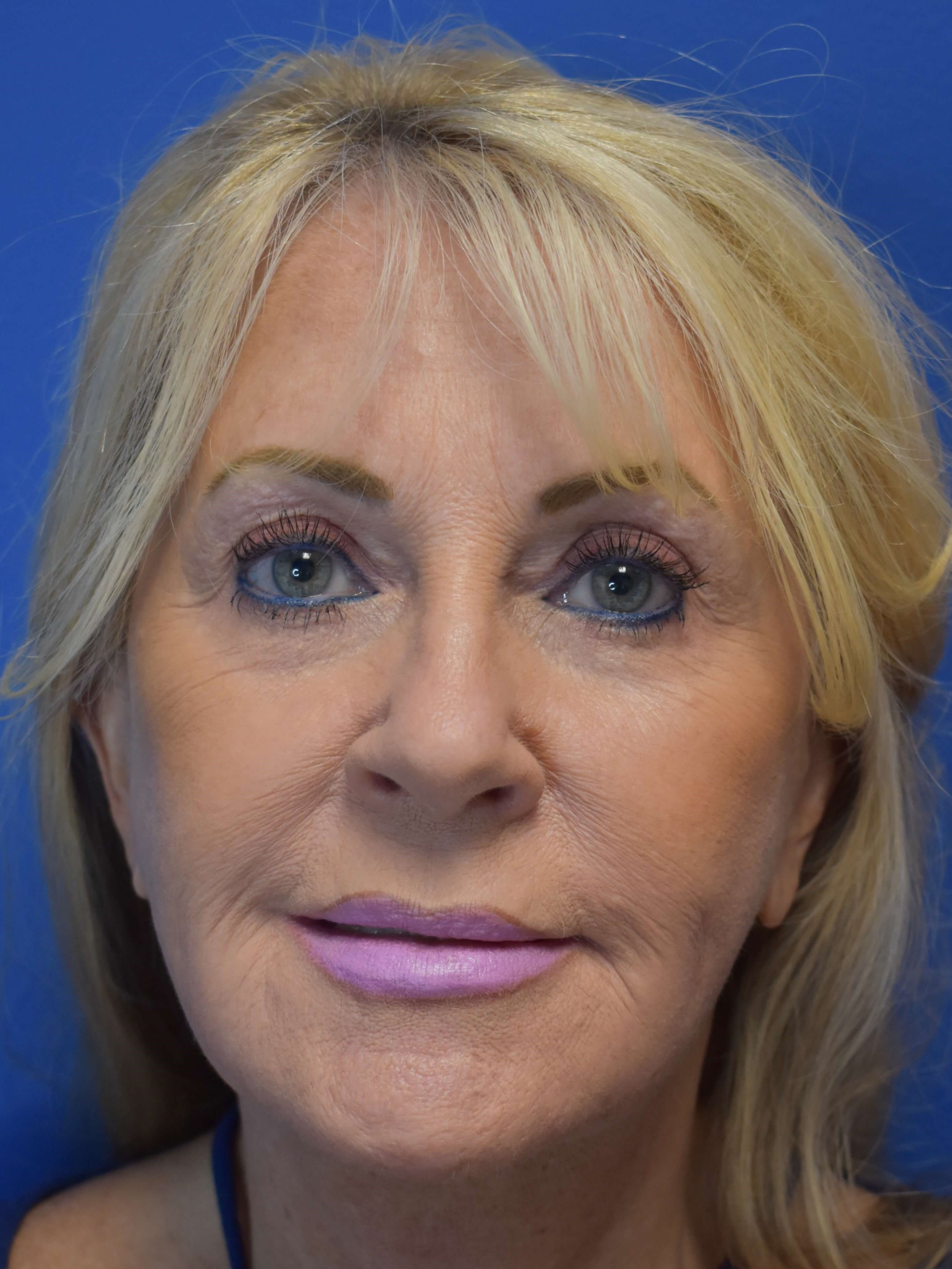 Full Face Rejuvenation After
