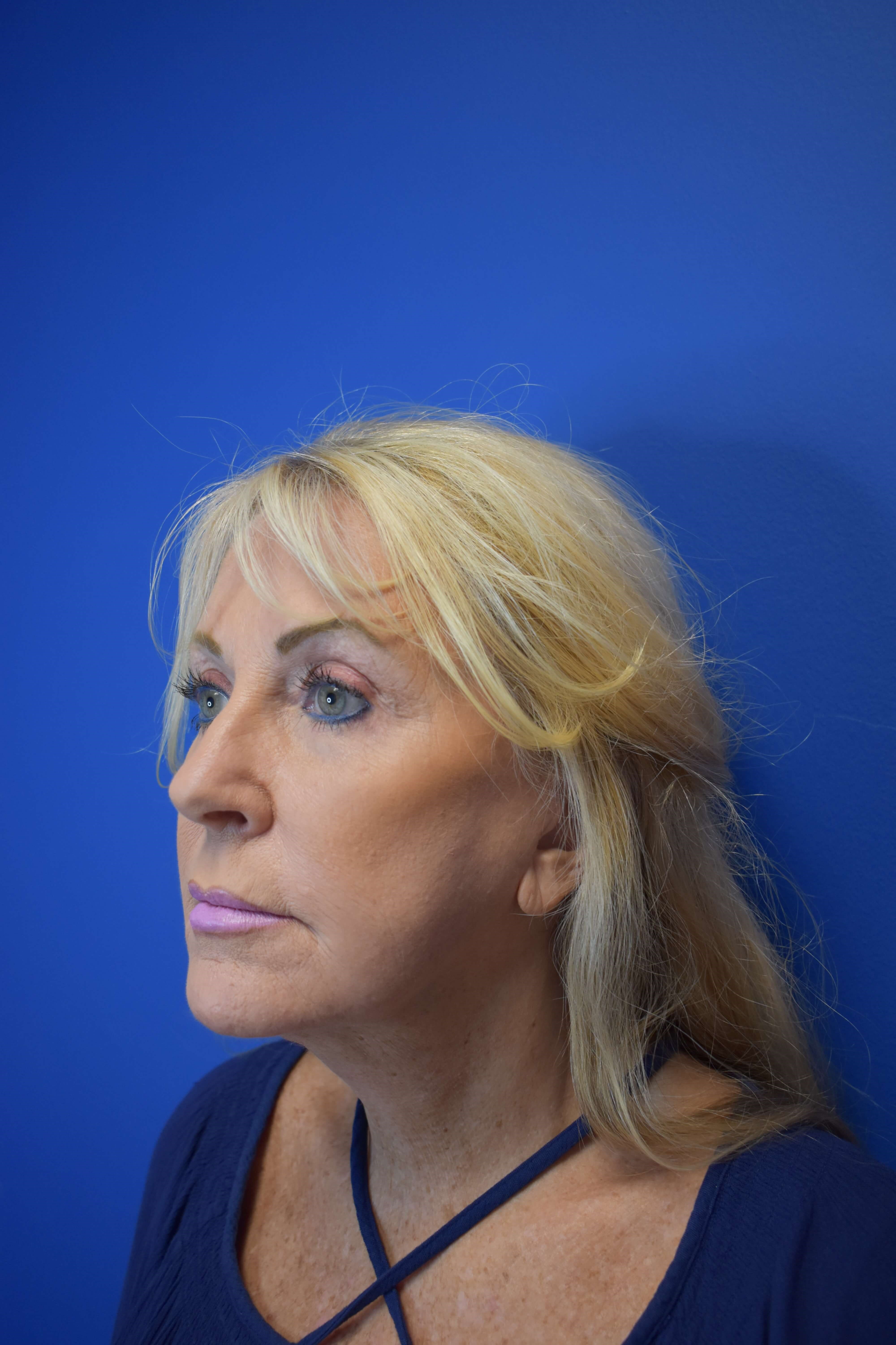 Full Face Rejuvenation After