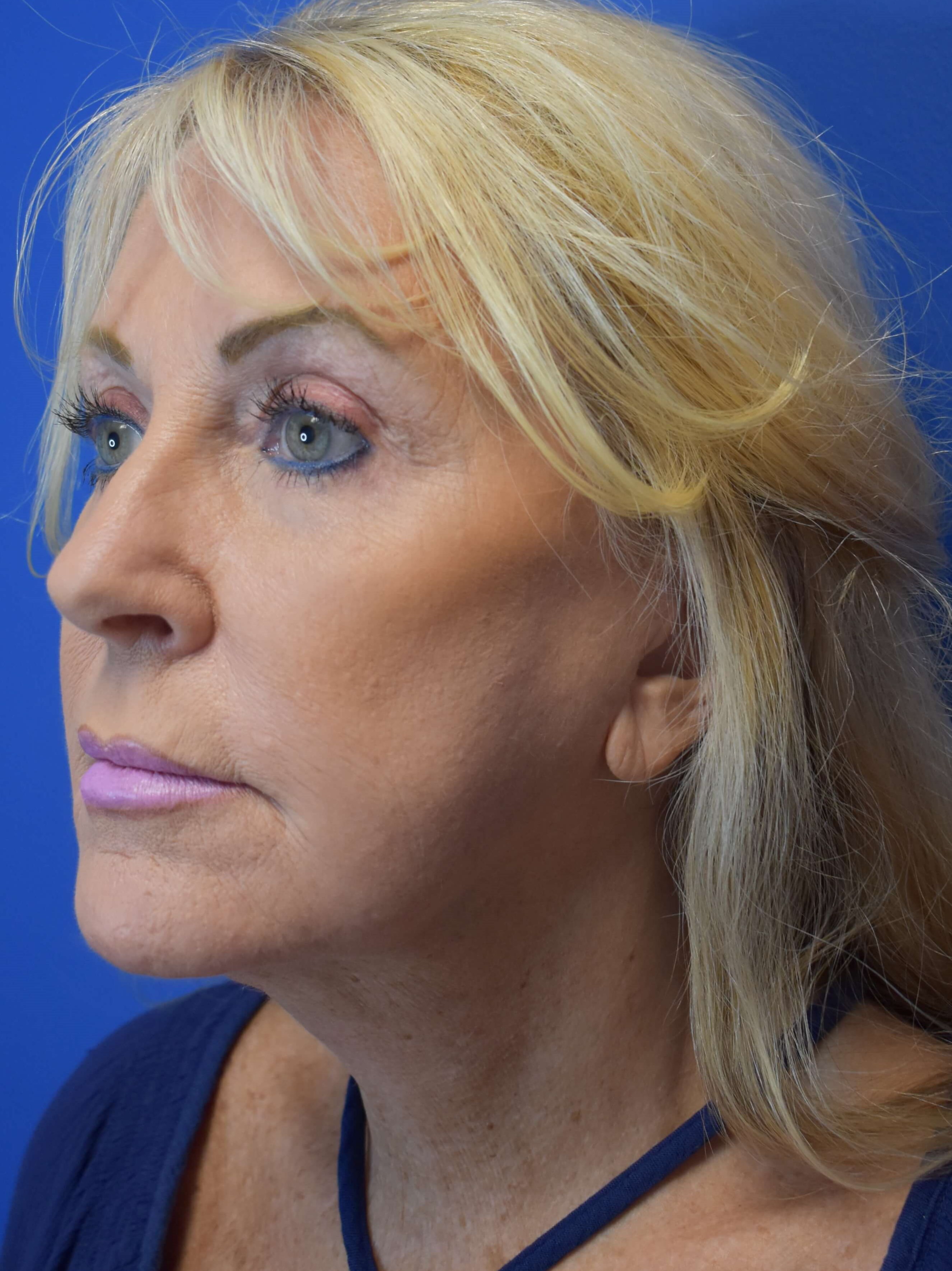 Full Face Rejuvenation After