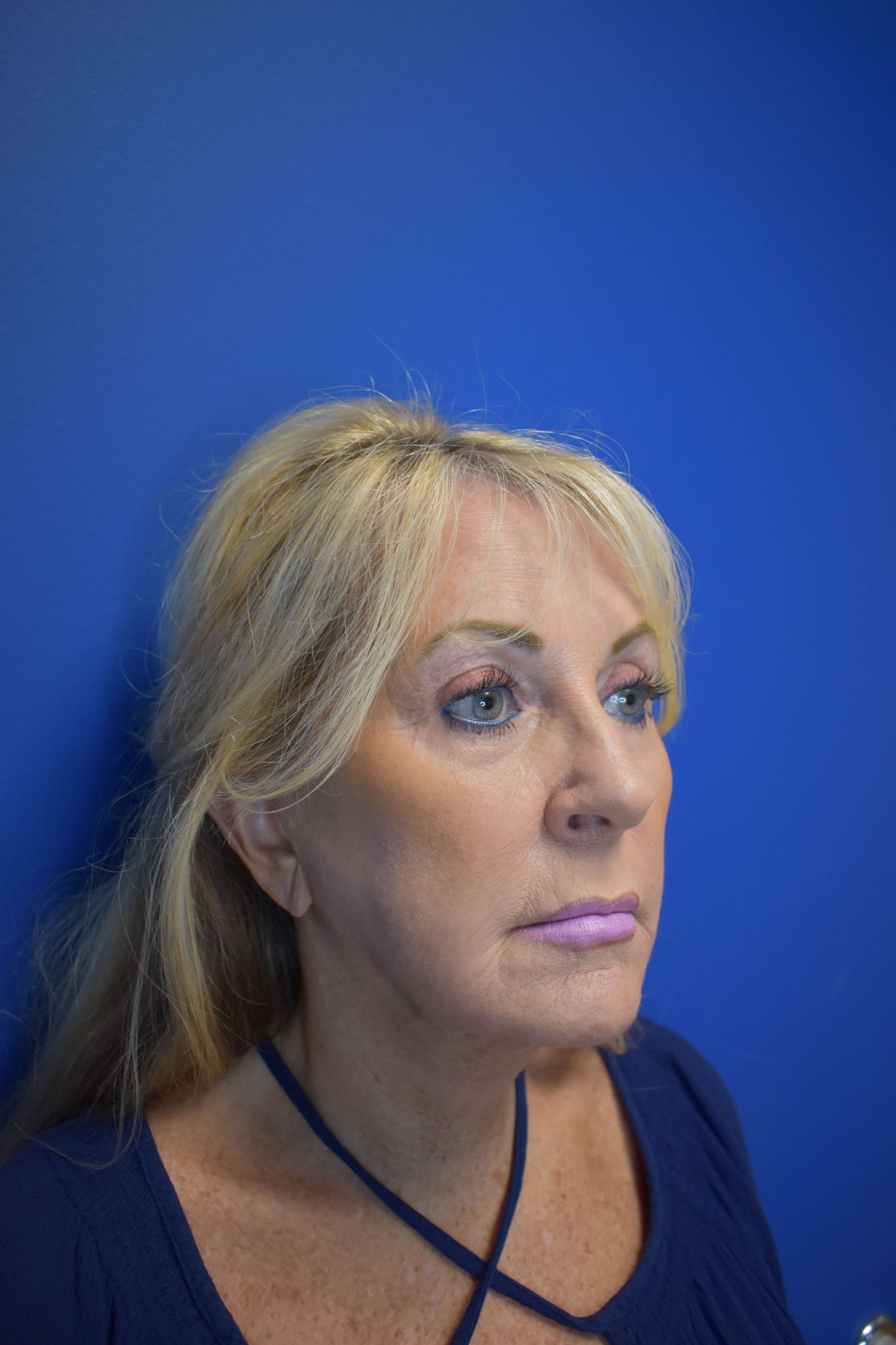 Full Face Rejuvenation After