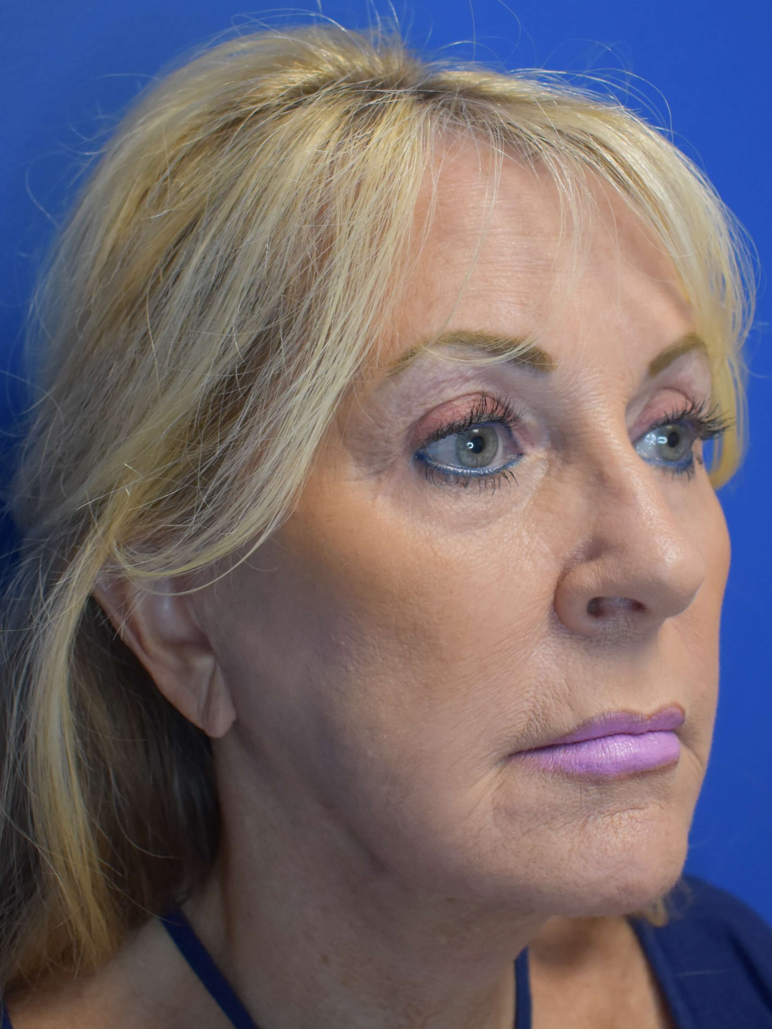 Full Face Rejuvenation After