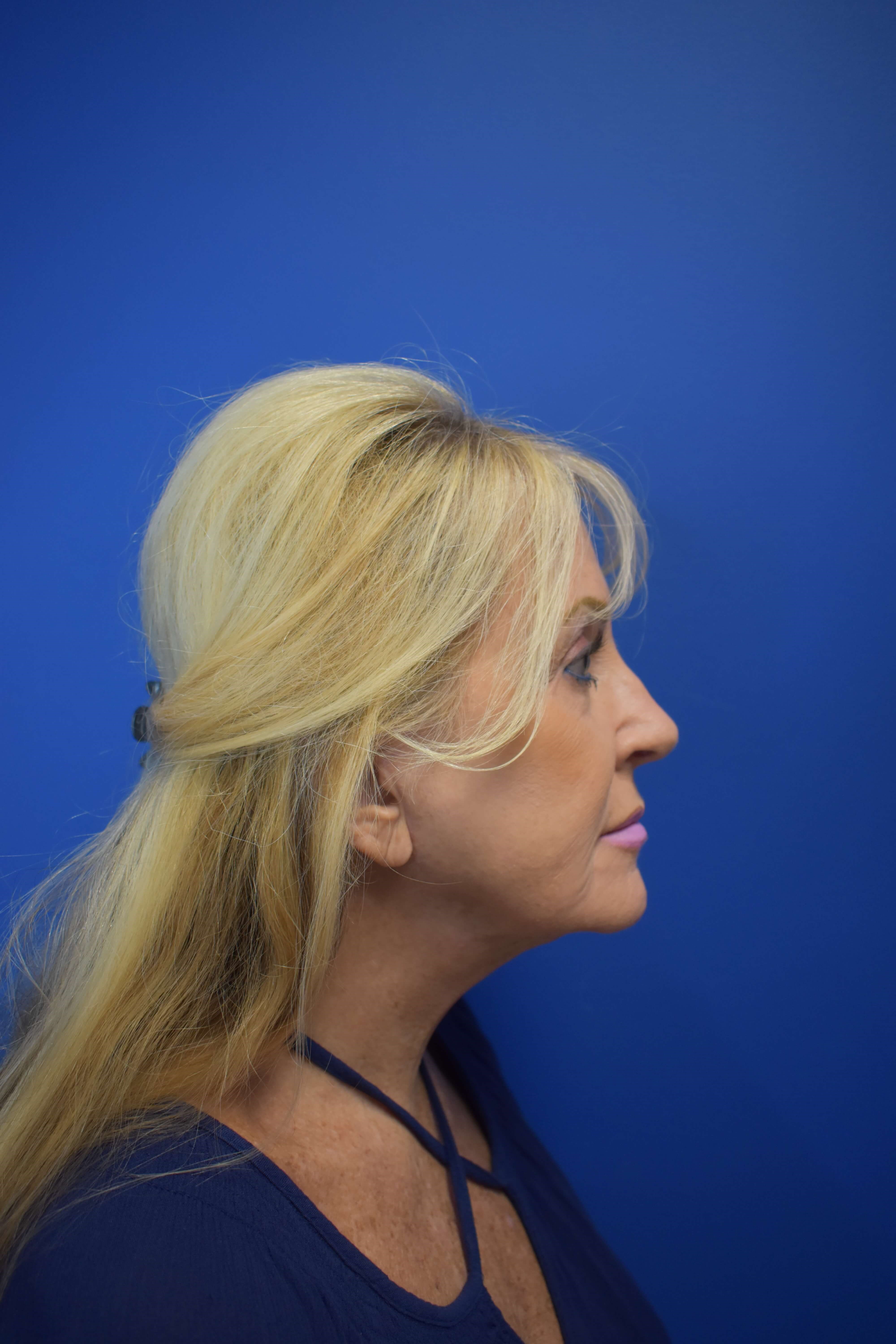 Full Face Rejuvenation After