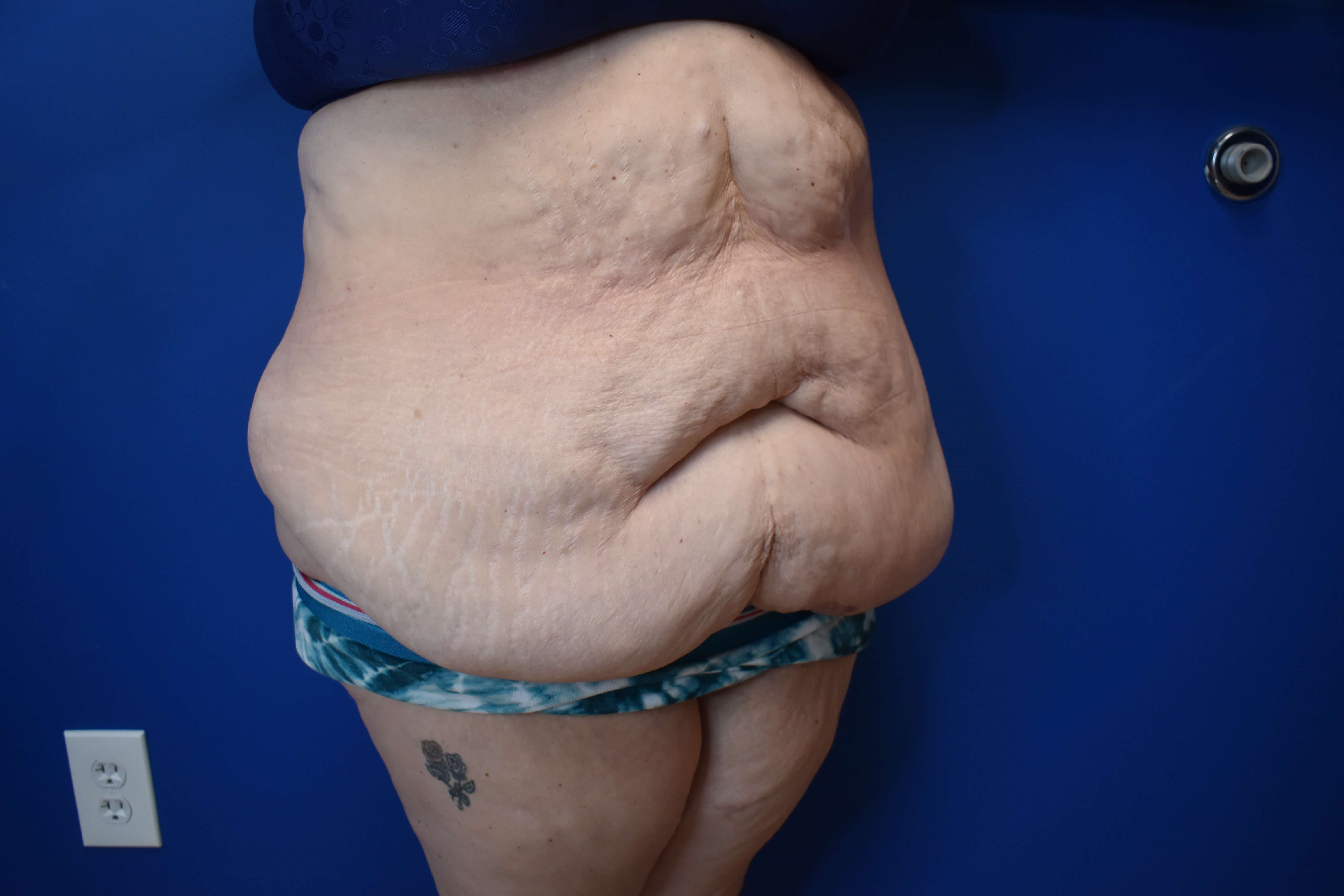 Tummy Tuck and Belt Lipectomy Before