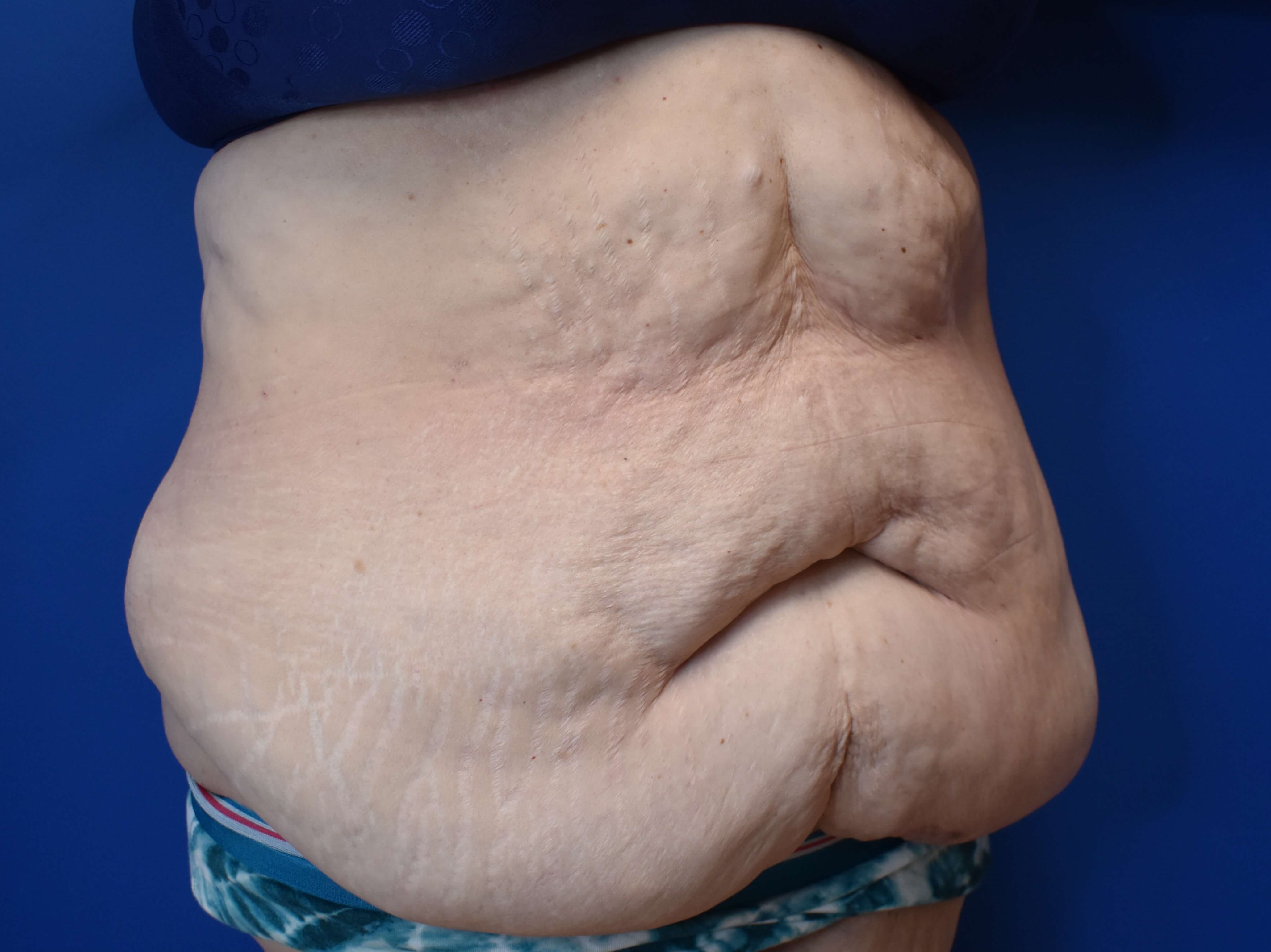 Tummy Tuck and Belt Lipectomy Before