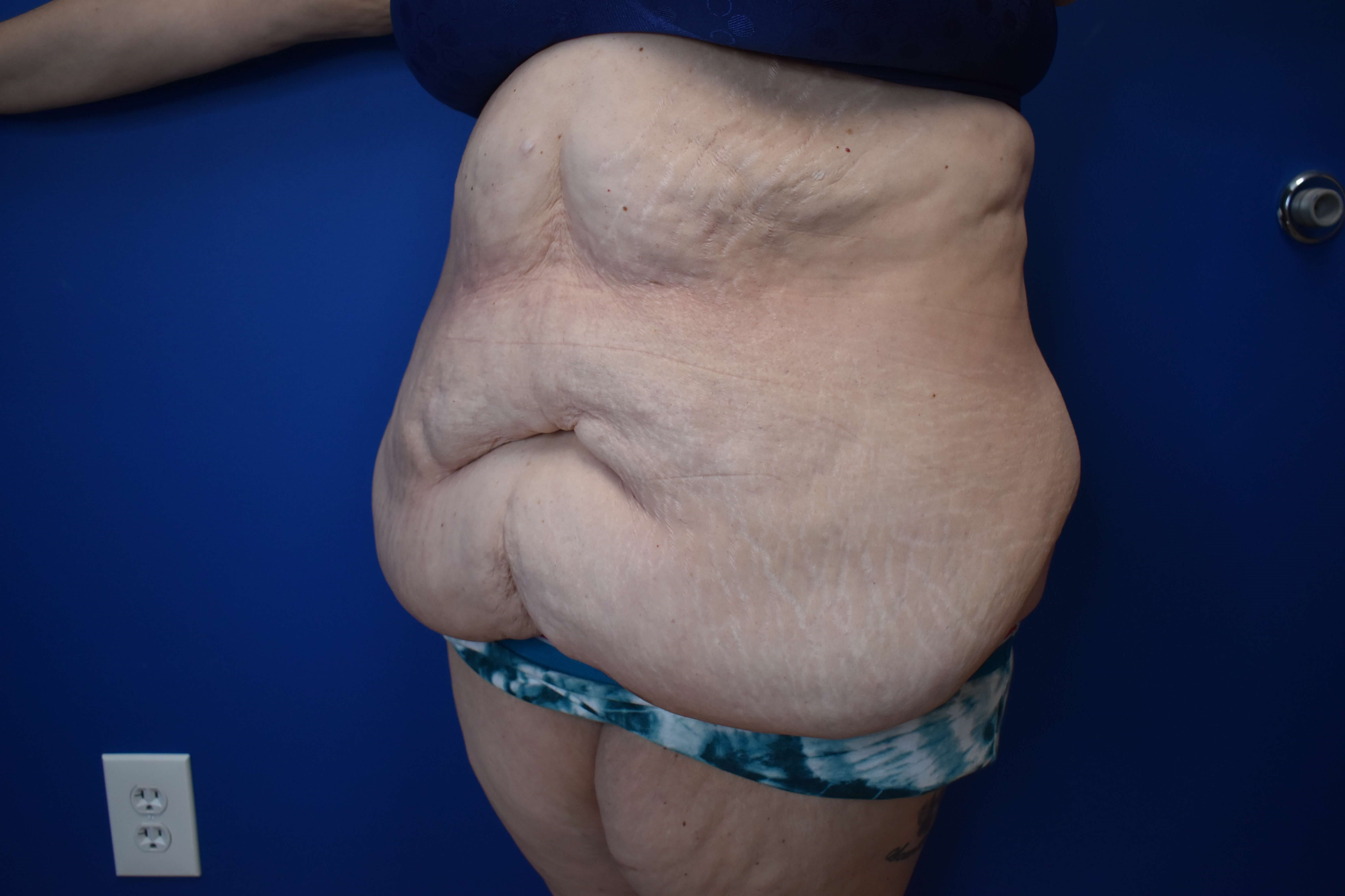 Tummy Tuck and Belt Lipectomy Before