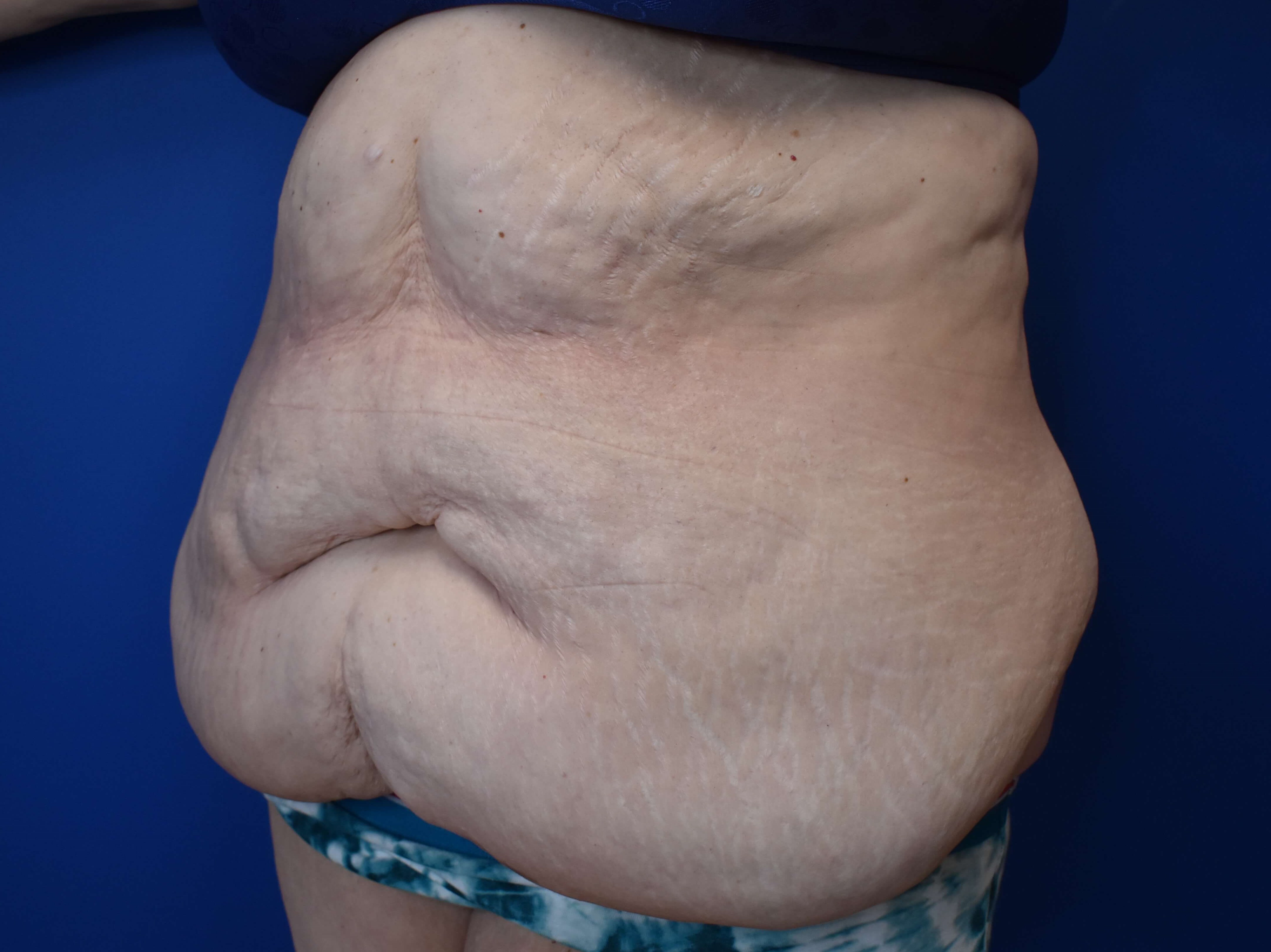 Tummy Tuck and Belt Lipectomy Before