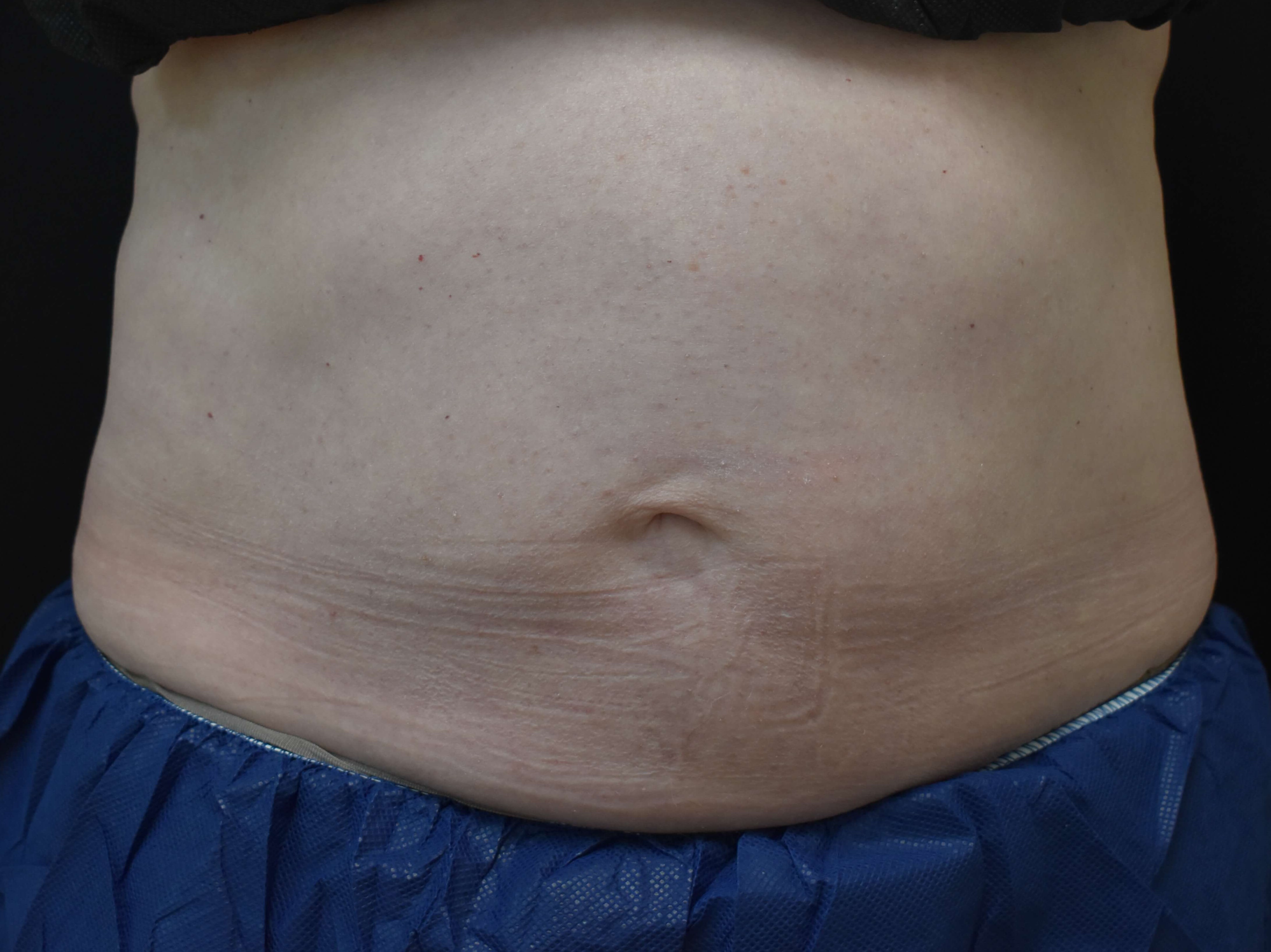 Coolsculpting Elite Abdomen After