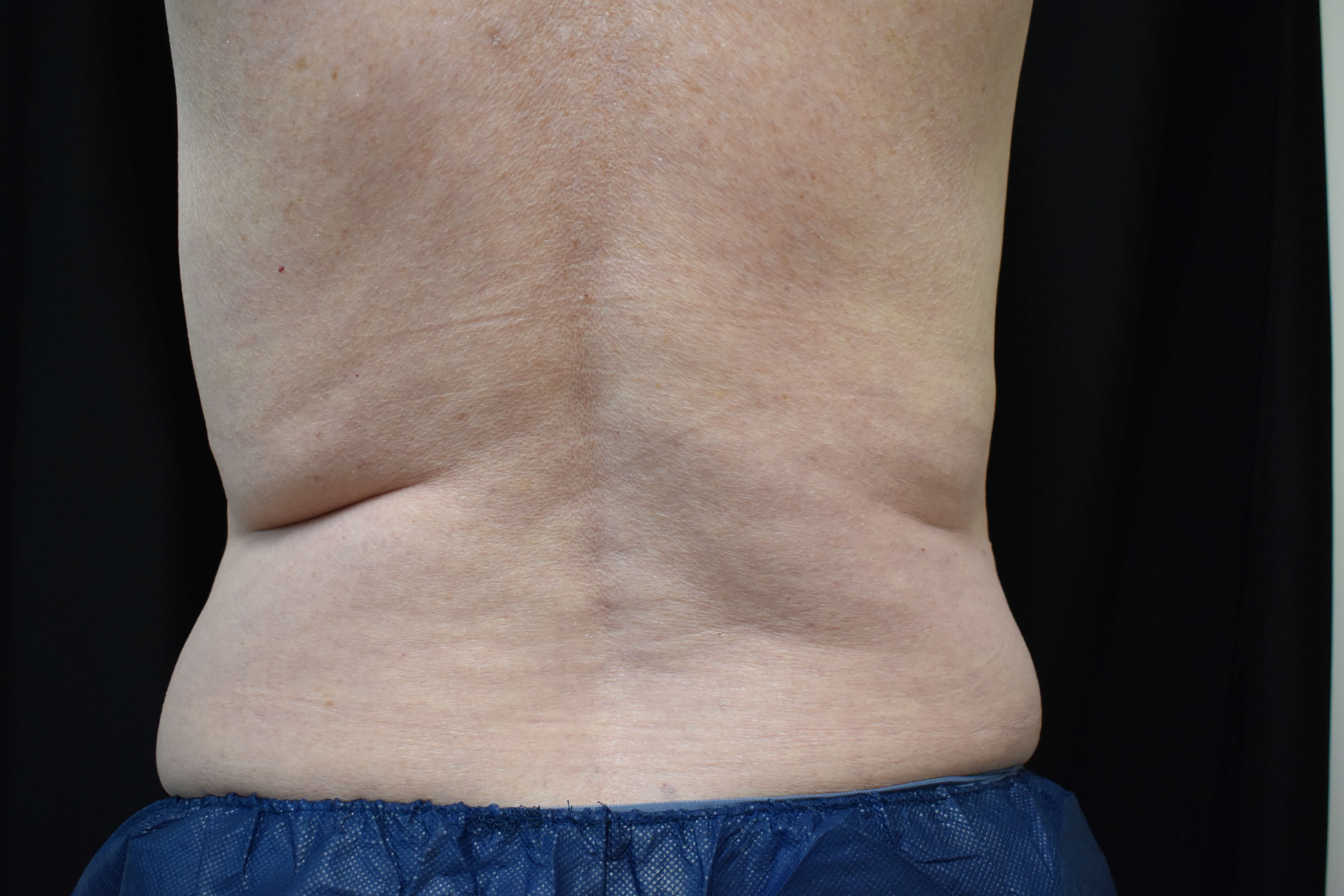 CoolSculpting Elite Bra Fat Before