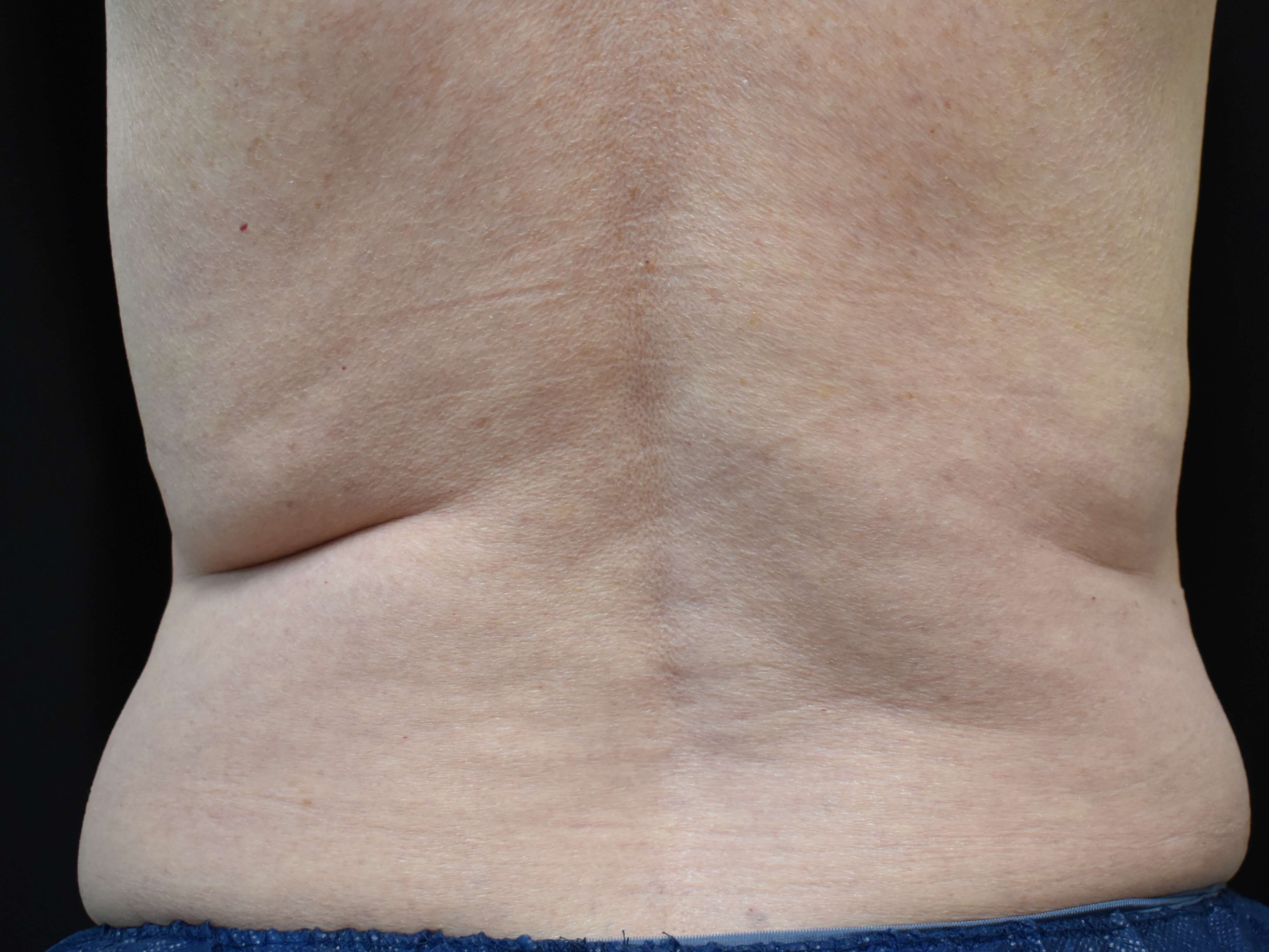 CoolSculpting Elite Bra Fat Before