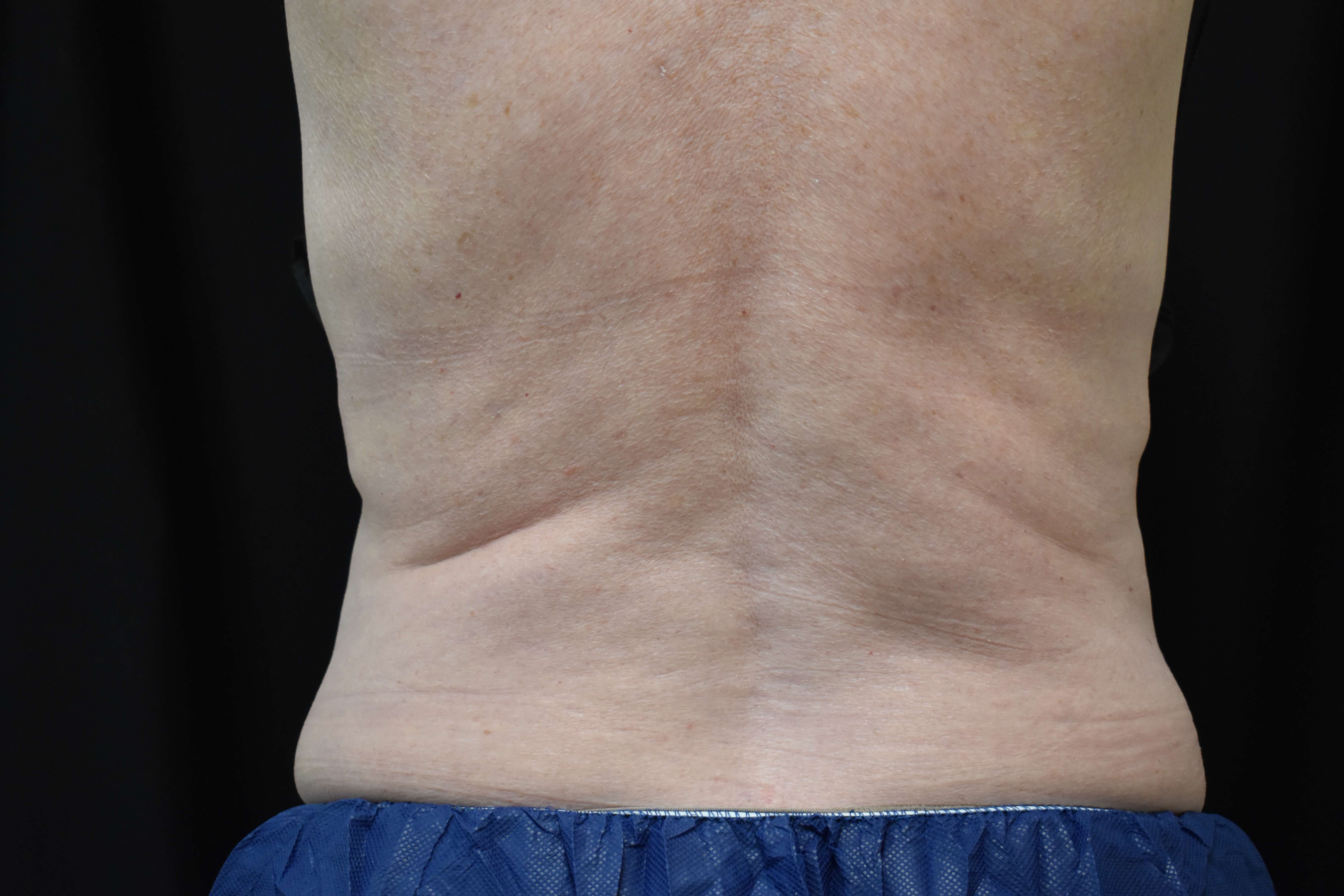 CoolSculpting Elite Bra Fat After