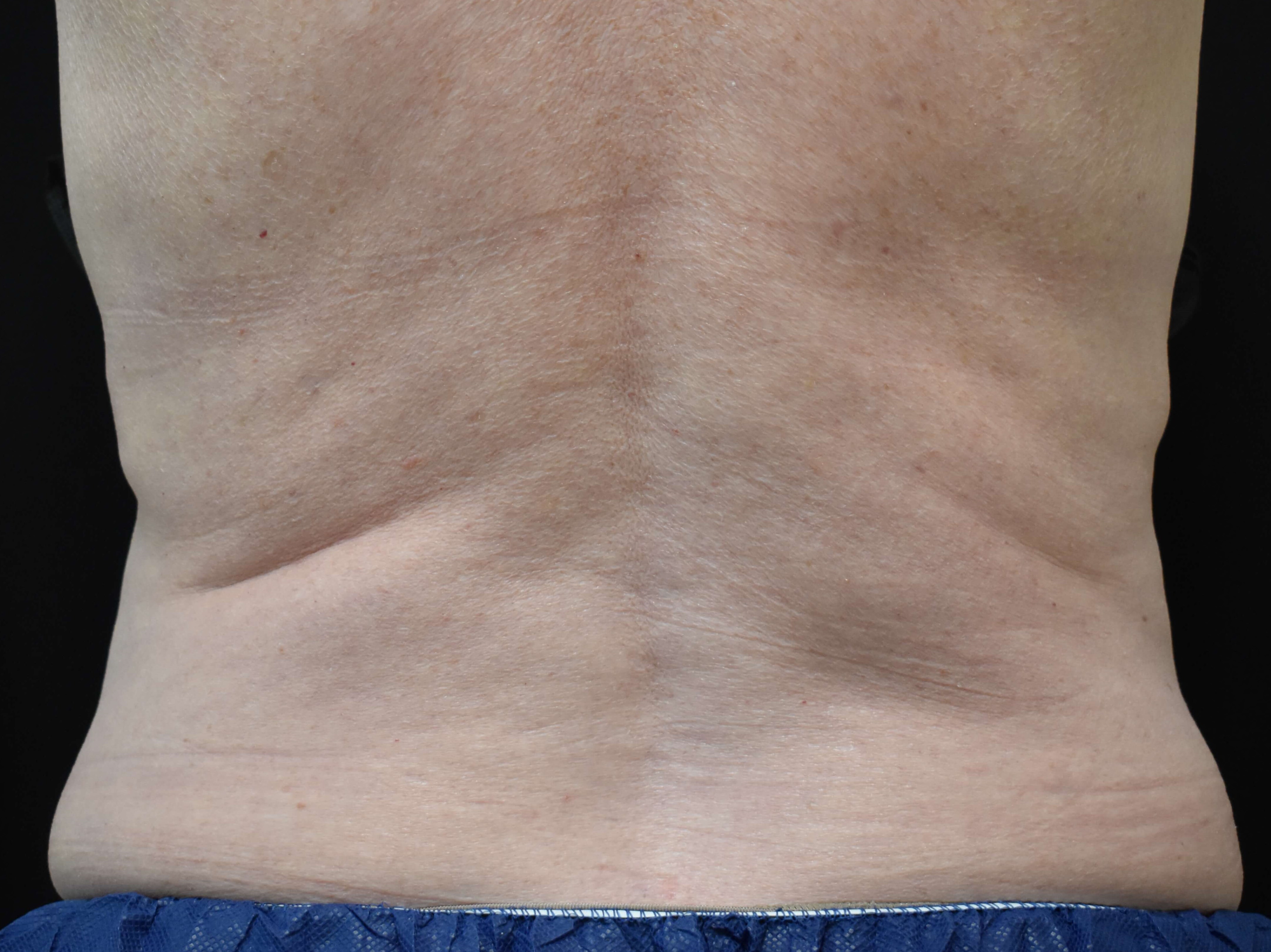 CoolSculpting Elite Bra Fat After