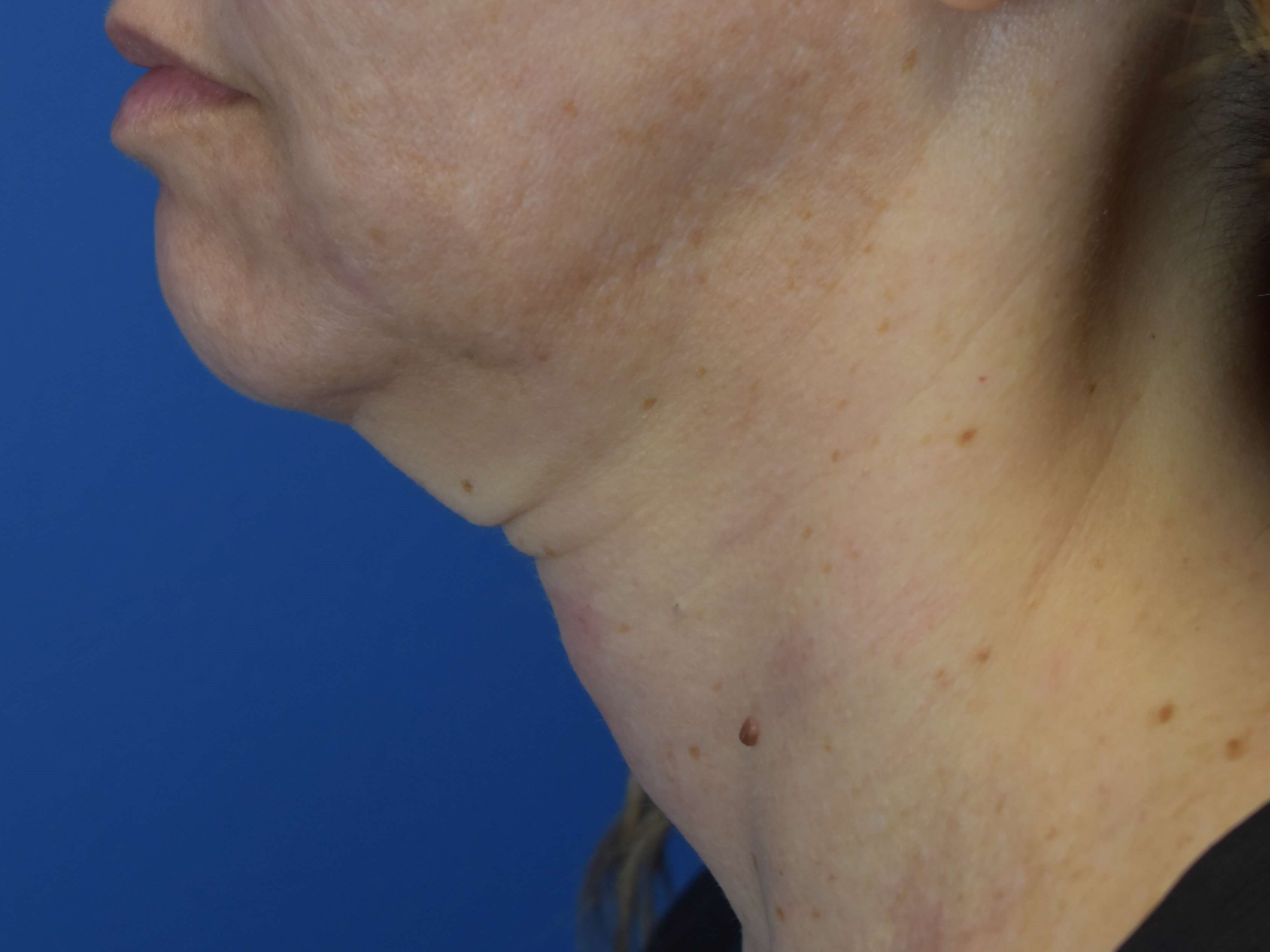 Neck Sofwave Before