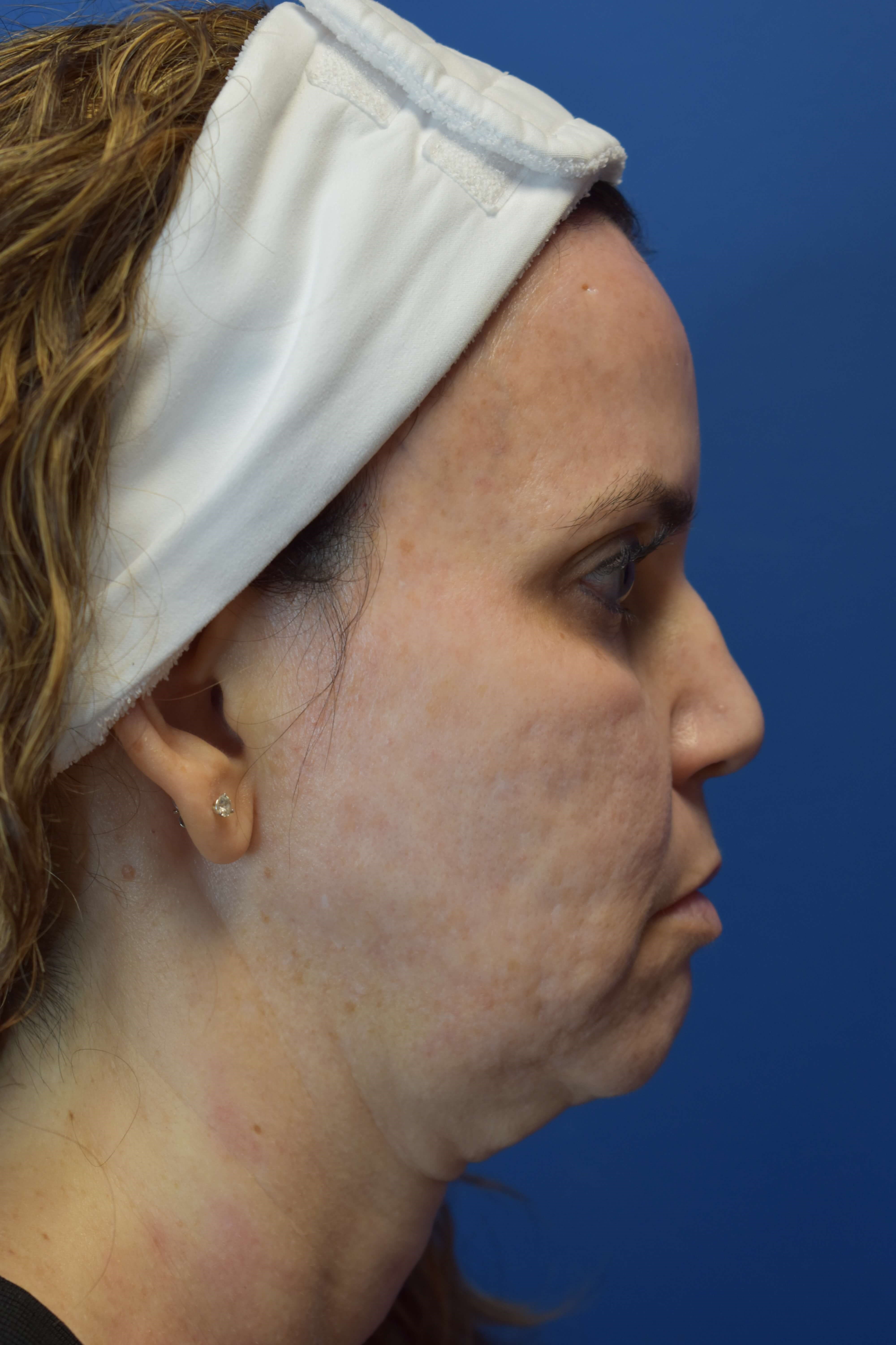 Neck Sofwave Before